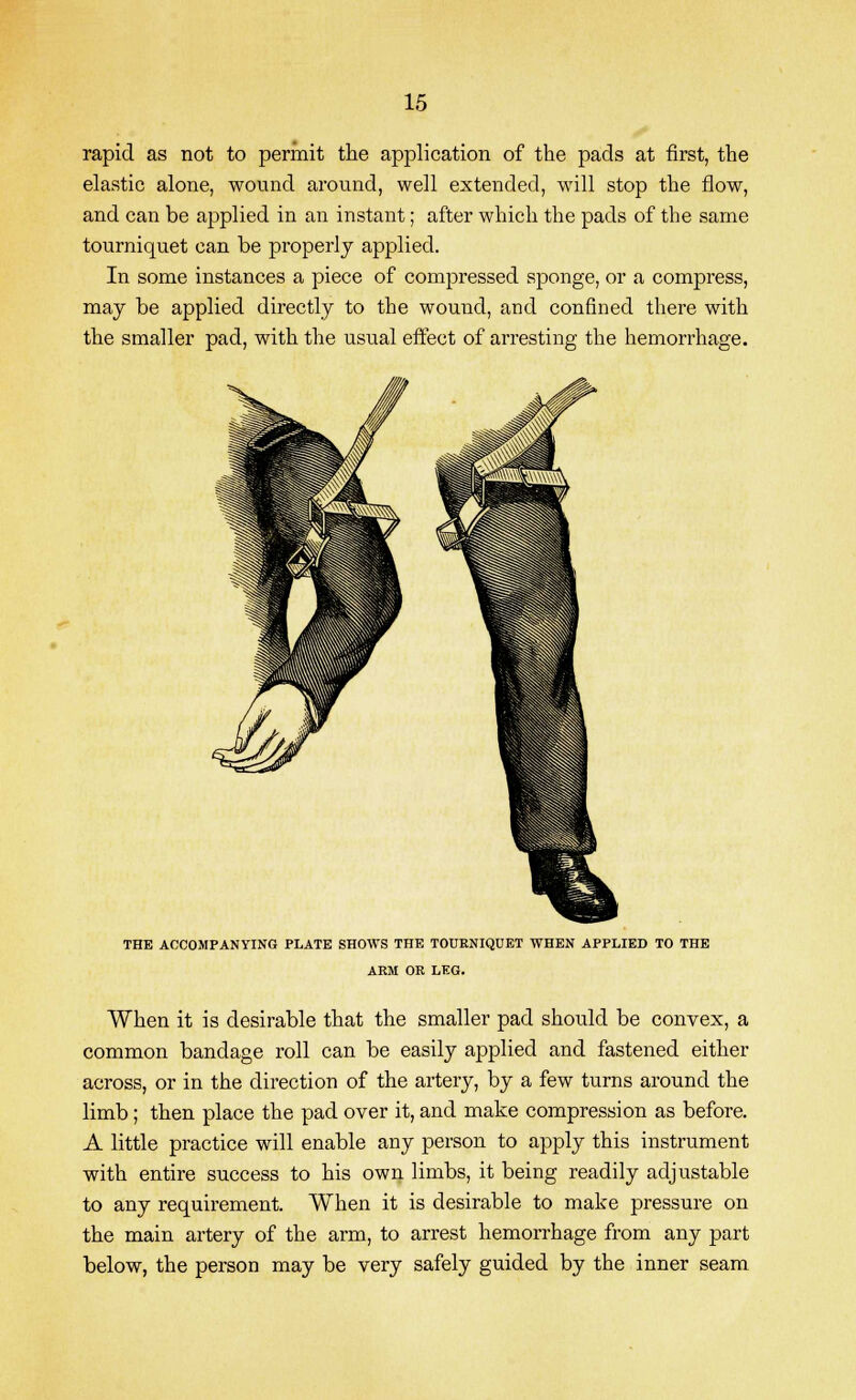 rapid as not to permit the application of the pads at first, the elastic alone, wound around, well extended, will stop the flow, and can be applied in an instant; after which the pads of the same tourniquet can be properly applied. In some instances a piece of compressed sponge, or a compress, may be applied directly to the wound, and confined there with the smaller pad, with the usual effect of arresting the hemorrhage. THE ACCOMPANYING PLATE SHOWS THE TOURNIQUET WHEN APPLIED TO THE ARM OR LEG. When it is desirable that the smaller pad should be convex, a common bandage roll can be easily applied and fastened either across, or in the direction of the artery, by a few turns around the limb; then place the pad over it, and make compression as before. A little practice will enable any person to apply this instrument with entire success to his own limbs, it being readily adjustable to any requirement. When it is desirable to make pressure on the main artery of the arm, to arrest hemorrhage from any part below, the person may be very safely guided by the inner seam