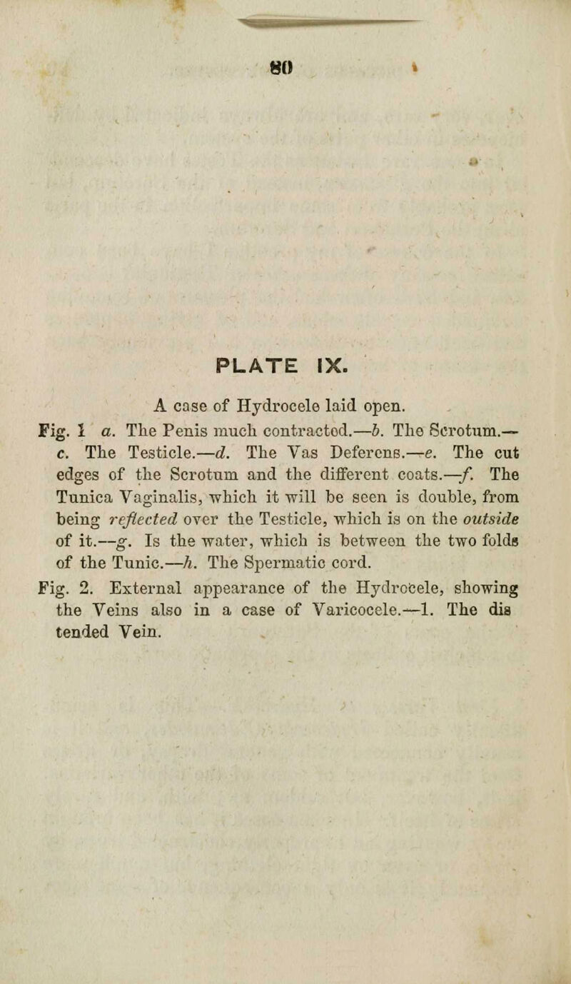 PLATE IX. A case of Hydrocele laid open. Fig. 1 a. The Penis much contracted.—b. The Scrotum.— c. The Testicle.—d. The Vas Deferens.—e. The cut edges of the Scrotum and the different coats.—/. The Tunica Vaginalis, which it will be seen is double, from being reflected over the Testicle, which is on the outside of it.—g. Is the water, which is between the two folds of the Tunic.—h. The Spermatic cord. Fig. 2. External appearance of the Hydrocele, showing the Veins also in a case of Varicocele. —1. The dis tended Vein.