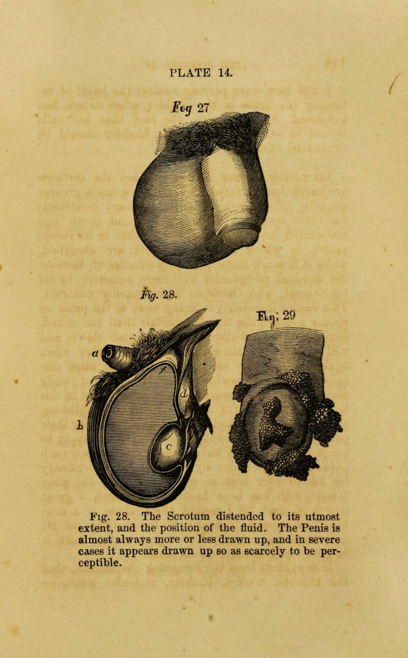 IV. 29 Fig. 28. The Scrotum distended to its utmost extent, and the position of the fluid. The Penis is almost always more or less drawn up, and in severe cases it appears drawn up so as scarcely to be per- ceptible.