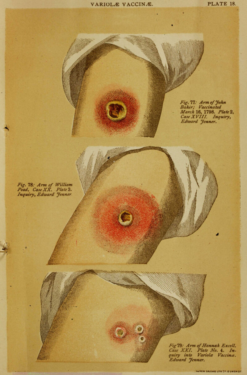 Fig. 77/ Arm of John Baker; Vaccinated March 16, 1798. Plate % Case XVIII. Inquiry, Edward Jenner. Fig. 78/ Arm of William % Pead. CaseXX. Plate*. Inquiry, Edward Jenner Fig 79: Arm of Hannah Excell. Case XXI. Plate No. 4. In- quiry into Variola Vaccina. Edward Jenner. iwlttW ORLEANS ltTH't« IOUHIONST