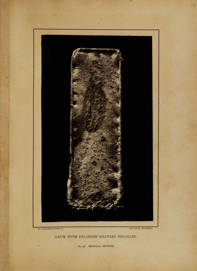 ILEUM WITH ENLARGED SOLITARY FOLLICLES. No. 98. MEDICAL SECTION.