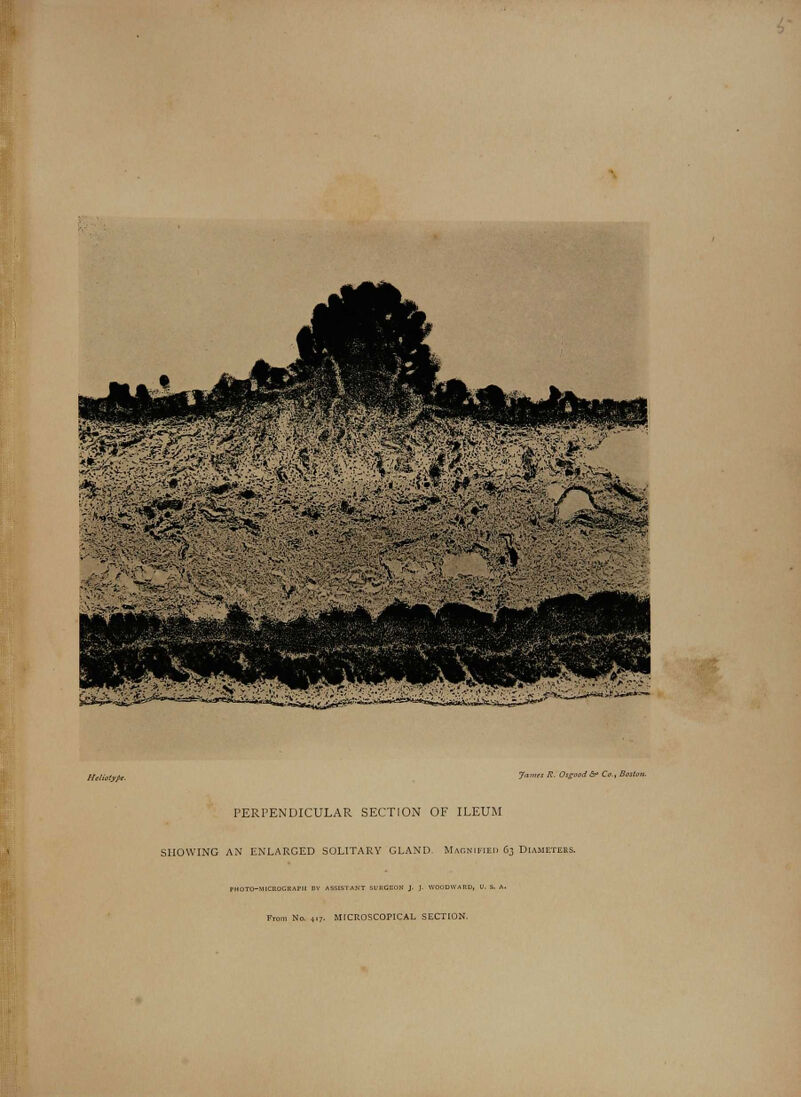 rvw ■ ^a«^3A**Bi*>«J[iJ-,,i*, 7«i»m /?. Osgood & Co., Boston PERPENDICULAR SECTION OF ILEUM SHOWING AN ENLARGED SOLITARY GLAND. Magnified 63 Bu From No. 417. MICROSCOPICAL SECTION.