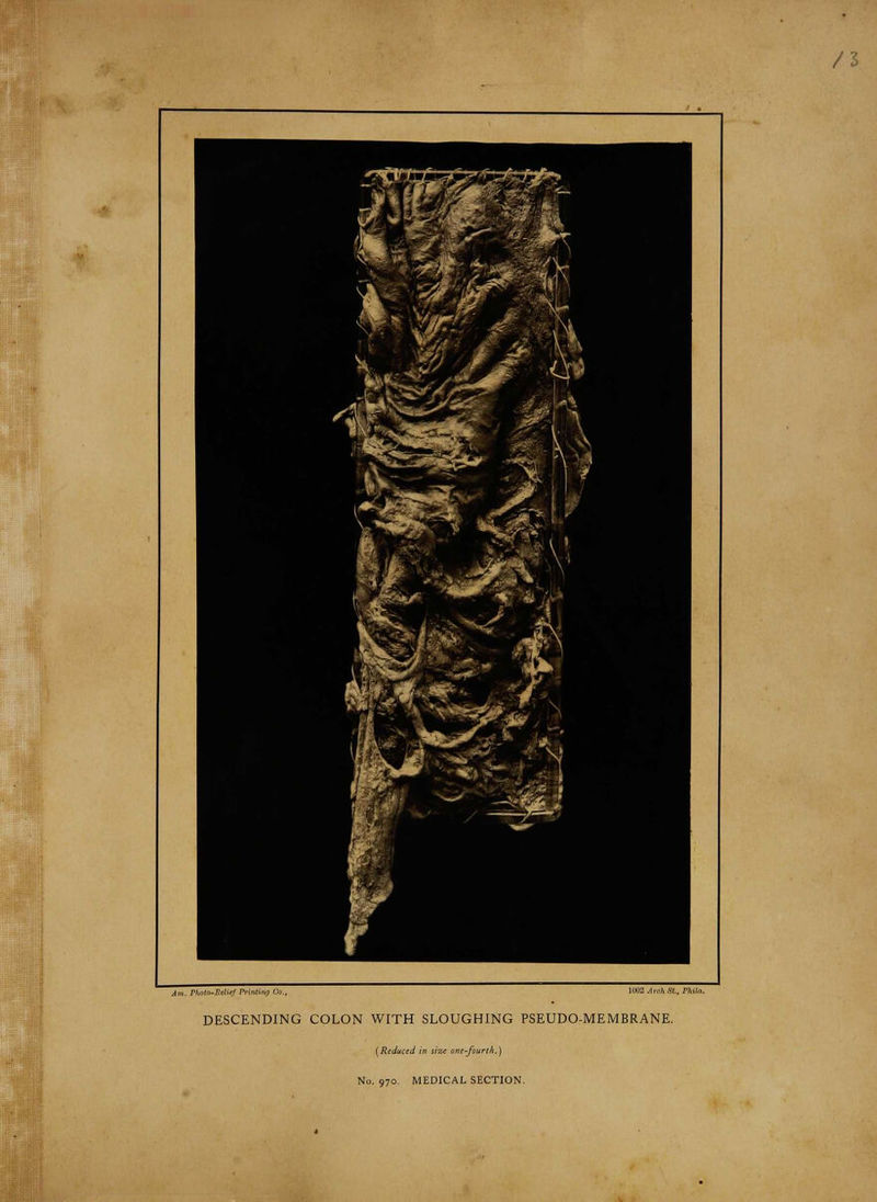 fr. 1'; ■■ 1 **&B'SimfWMk K. '1 ' '****&:& 1! f 3 DESCENDING COLON WITH SLOUGHING PSEUDO-MEMBRANE. (Reduced in sia ant-fiurih.) No. 970 MEDICAL SECTION.