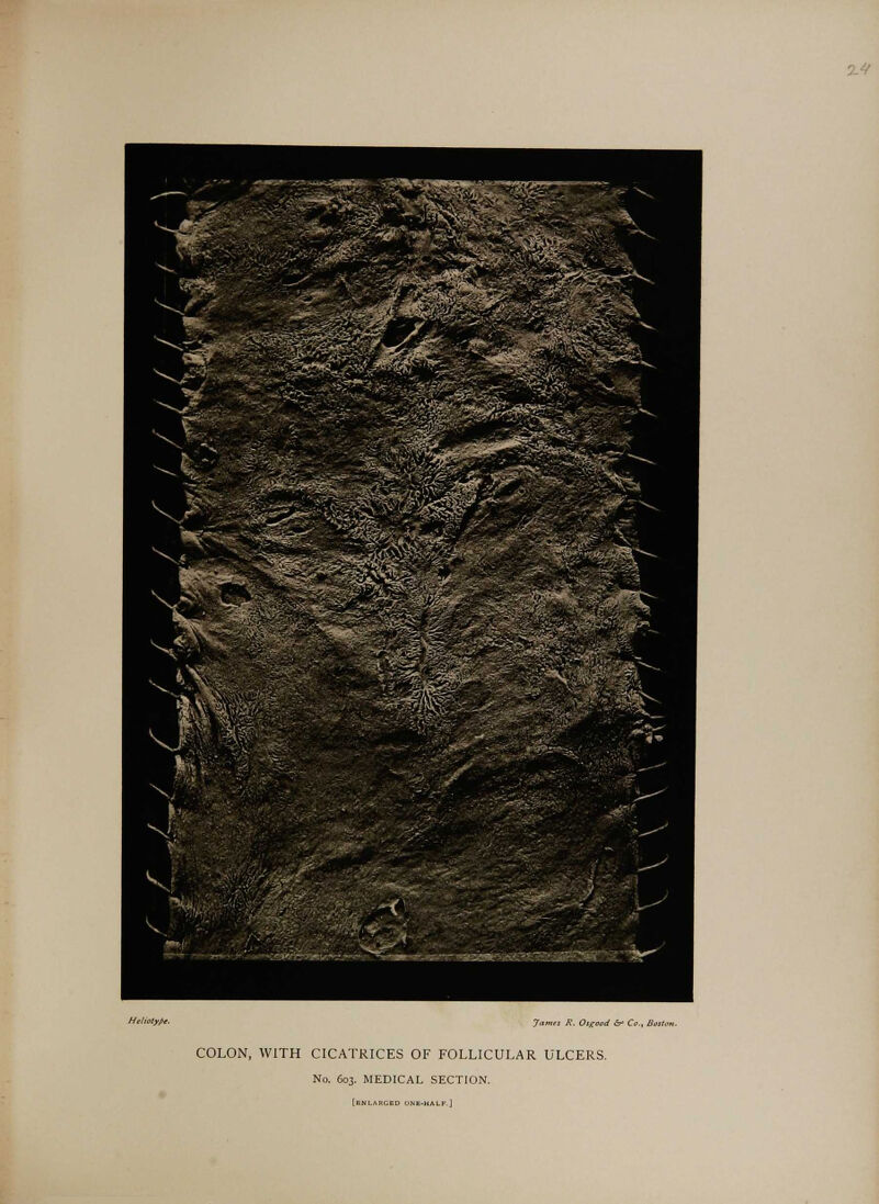 COLON, WITH CICATRICES OF FOLLICULAR ULCERS. No. 603. MEDICAL SECTION.