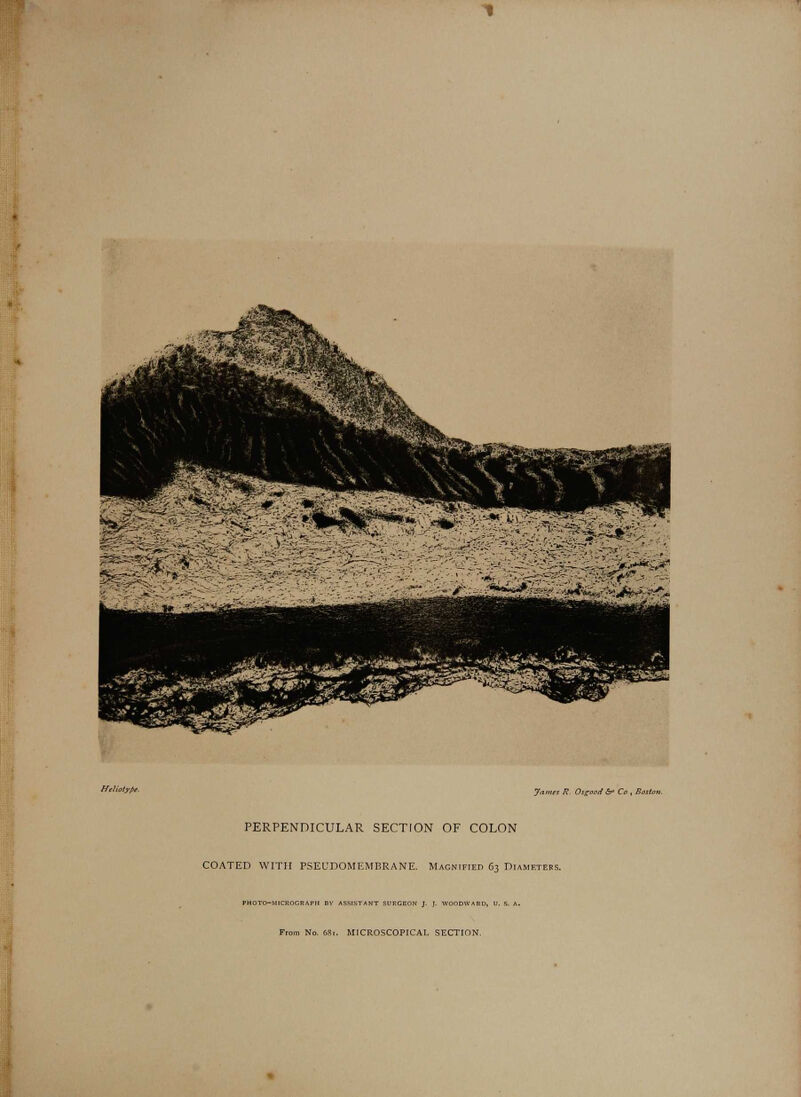 James R. Osgood fin Co , Bostot PERPENDICULAR SECTION OF COLON COATED WITH PSEUDOMEMBRANE. Magnified 63 Dia From No. 6Sx. MICROSCOPICAL SECTION.