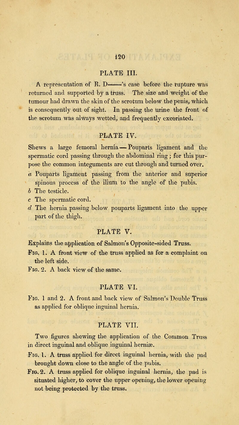 120 PLATE III. A representation of R. D 's case before the rupture was returned and supported by a truss. The size and weight of the tumour had drawn the skin of the scrotum below the penis, which is consequently out of sight. In passing the urine the front of the scrotum was always wetted, and frequently excoriated. PLATE IV. Shews a large femoral hernia — Pouparts ligament and the spermatic cord passing through the abdominal ring ; for this pur- pose the common integuments are cut through and turned over. a Pouparts ligament passing from the anterior and superior spinous process of the ilium to the angle of the pubis. b The testicle. c The spermatic cord. d The hernia passing below pouparts ligament into the upper part of the thigh. PLATE V. Explains the application of Salmon's Opposite-sided Truss. Fig. 1. A front view of the truss applied as for a complaint on the left side. Fig. 2. A back view of the same. PLATE VI. Fig. 1 and 2. A front and back view of Salmon's Double Truss as applied for oblique inguinal hernia. PLATE VII. Two figures shewing the application of the Common Truss in direct inguinal and oblique inguinal herniae. Fig. I. A truss applied for direct inguinal hernia, with the pad brought down close to the angle of the pubis. Fig. 2. A truss applied for oblique inguinal hernia, the pad is situated higher, to cover the upper opening, the lower opening not being protected by the truss.