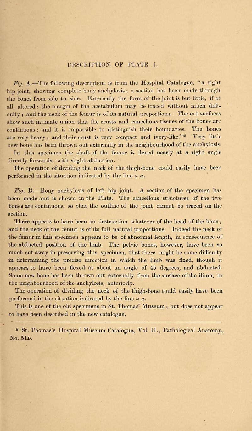 Fig. A.—The following description is from the Hospital Catalogue,  a right hip joint, showing complete bony anchylosis; a section has been made through the bones from side to side. Externally the form of the joint is but little, if at all, altered: the margin of the acetabulum may be traced without much diffi- culty ; and the neck of the femur is of its natural proportions. The cut surfaces show such intimate union that the crusts and cancellous tissues of the bones are continuous ; and it is impossible to distinguish their boundaries. The bones are very heavy ; and their crust is very compact and ivory-like.* Very little new bone has been thrown out externally in the neighbourhood of the anchylosis. In this specimen the shaft of the femur is flexed nearly at a right angle directly forwards, with slight abduction. The operation of dividing the neck of the thigh-bone could easily have been performed in the situation indicated by the line a a. Fig. B.—Bony anchylosis of left hip joint. A section of the specimen has been made and is shown in the Plate. The cancellous structures of the two bones are continuous, so that the outline of the joint cannot be traced on the section. There appears to have been no destruction whatever of the head of the bone ; and the neck of the femur is of its full natural proportions. Indeed the neck of the femur in this specimen appears to be of abnormal length, in consequence of the abducted position of the limb. The pelvic bones, however, have been so much cut away in preserving this specimen, that there might be some difficulty in determining the precise direction in which the limb was fixed, though it appears to have been flexed at about an angle of 45 degrees, and abducted. Some new bone has been thrown out externally from the surface of the ilium, in the neighbourhood of the anchylosis, anteriorly. The operation of dividing the neck of the thigh-bone could easily have been performed in the situation indicated by the line a a. This is one of the old specimens in St. Thomas' Museum; but does not appear to have been described in the new catalogue. * St. Thomas's Hospital Museum Catalogue, Vol. II., Pathological Anatomy, No. 51d.