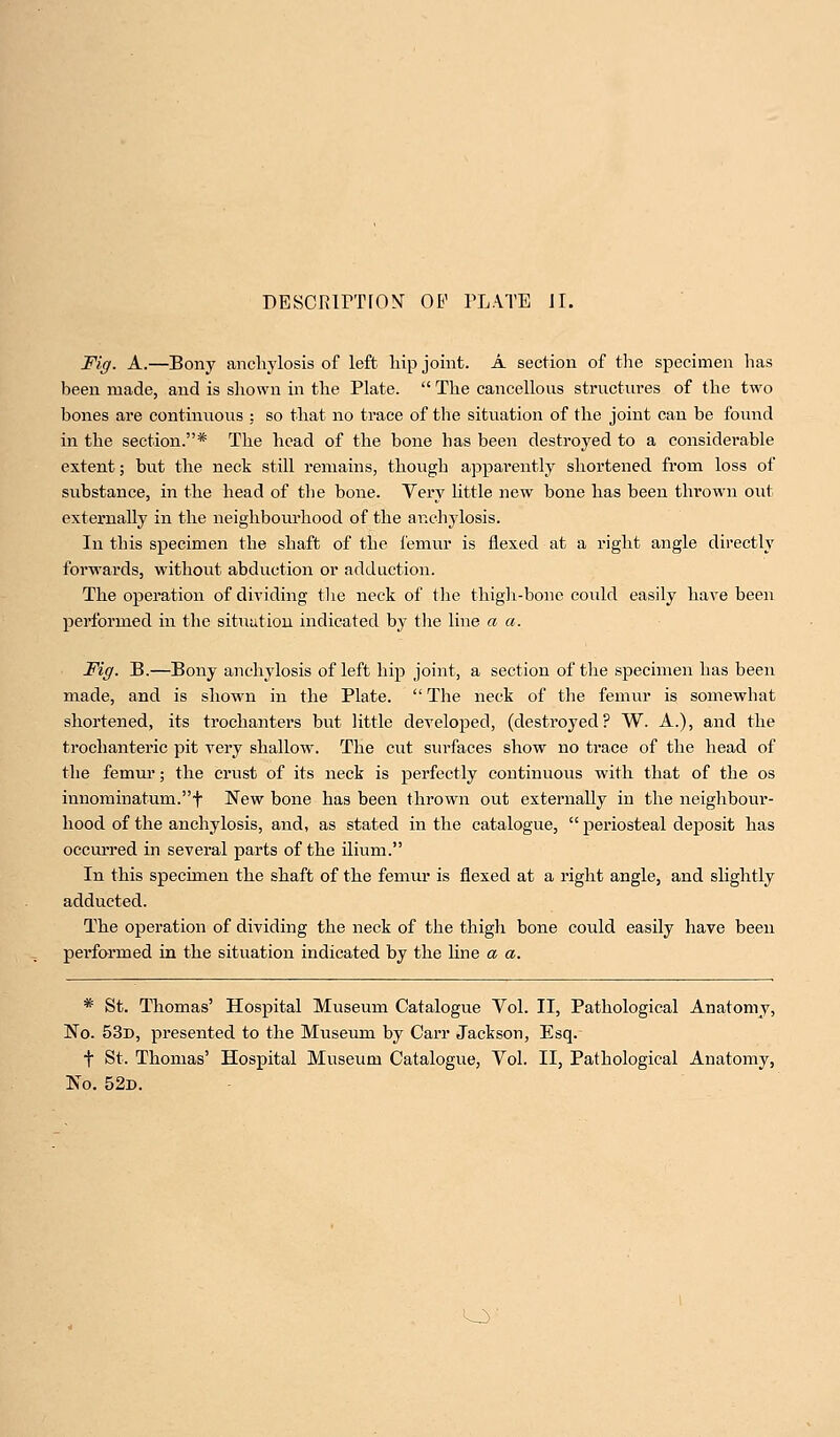 Fig. A.—Bony anchylosis of left hip joint. A section of the specimen has been made, and is shown in the Plate.  The cancellous structures of the two bones are continuous ; so that no trace of the situation of the joint can be found in the section.* The head of the bone has been destroyed to a considerable extent; but the neck still remains, though apparently shortened from loss of substance, in the head of the bone. Very little new bone has been thrown out externally in the neighbourhood of the anchylosis. In this specimen the shaft of the lemur is flexed at a right angle directly forwards, without abduction or adduction. The operation of dividing the neck of the thigh-bone could easily have been performed in the situation indicated by the line a a. Fig. B.—Bony anchylosis of left hip joint, a section of the specimen has been made, and is shown in the Plate.  The neck of the femur is somewhat shortened, its trochanters but little developed, (destroyed? W. A.), and the trochanteric pit very shallow. The cut surfaces show no trace of the head of the femur; the crust of its neck is perfectly continuous with that of the os innominatum.t New bone has been thrown out externally in the neighbour- hood of the anchylosis, and, as stated in the catalogue,  periosteal deposit has occurred in several parts of the ilium. In this specimen the shaft of the femur is flexed at a right angle, and slightly adducted. The operation of dividing the neck of the thigh bone could easily have been performed in the situation indicated by the line a a. * St. Thomas' Hospital Museum Catalogue Yol. II, Pathological Anatomy, No. 53d, presented to the Museum by Carr Jackson, Esq. f St. Thomas' Hospital Museum Catalogue, Vol. II, Pathological Anatomy, No. 52d. O