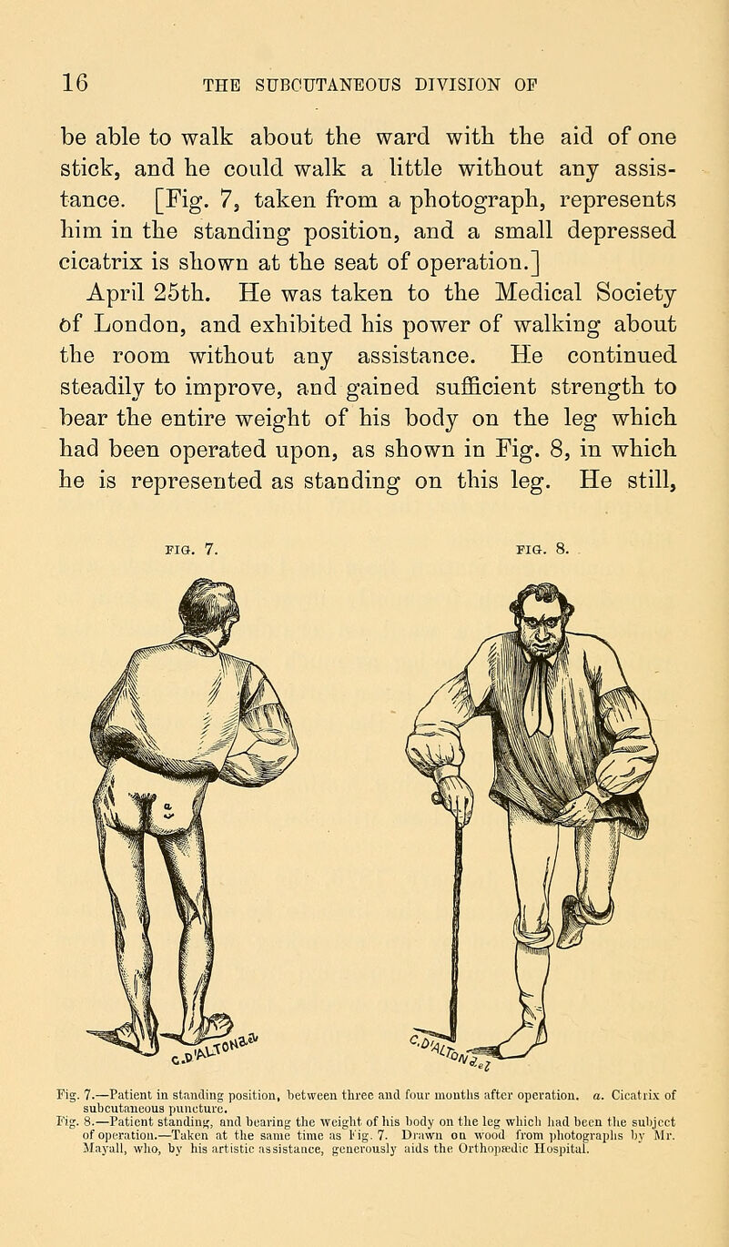 be able to walk about the ward with the aid of one stick, and he could walk a little without any assis- tance. [Fig. 7, taken from a photograph, represents him in the standing position, and a small depressed cicatrix is shown at the seat of operation.] April 25th. He was taken to the Medical Society of London, and exhibited his power of walking about the room without any assistance. He continued steadily to improve, and gained sufficient strength to bear the entire weight of his body on the leg which had been operated upon, as shown in Fig. 8, in which he is represented as standing on this leg. He still, FIG. 7. FIG. 8. Jfc* Fig. 7.—Patient in standing position, between three and four months after operation, a. Cicatrix of subcutaneous puncture. Pig. 8.—Patient standing, and bearing the weight of his body on the leg which had been the subject of operation.—Taken at the same time as Fig. 7. Drawn on wood from photographs by Mr. Mayall, who, by his artistic assistance, generously aids the Orthopeedic Hospital.