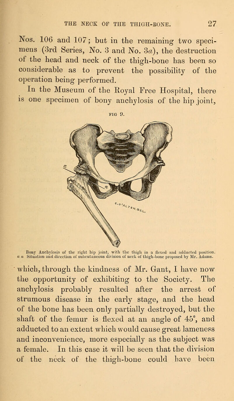 Nos. 106 and 107; but in the remaining two speci- mens (3rd Series, No. 3 and No. 3a), the destruction of the head and neck of the thigh-bone has been so considerable as to prevent the possibility of the operation being performed. In the Museum of the Royal Free Hospital, there is one specimen of bony anchylosis of the hip joint, TIG 9. Bony Anchylosis of the right hip joint, with the thigh in a flexed and adducted position. a a Situation and direction of subcutaneous division of neck of thigh-hone proposed by Mr. Adams. which, through the kindness of Mr. Gant, I have now the opportunity of exhibiting to the Society. The anchylosis probably resulted after the arrest of strumous disease in the early stage, and the head of the bone has been only partially destroyed, but the shaft of the femur is flexed at an angle of 45°, and adducted to an extent which would cause great lameness and inconvenience, more especially as the subject was a female. In this case it will be seen that the division of the neck of the thigh-bone could have been