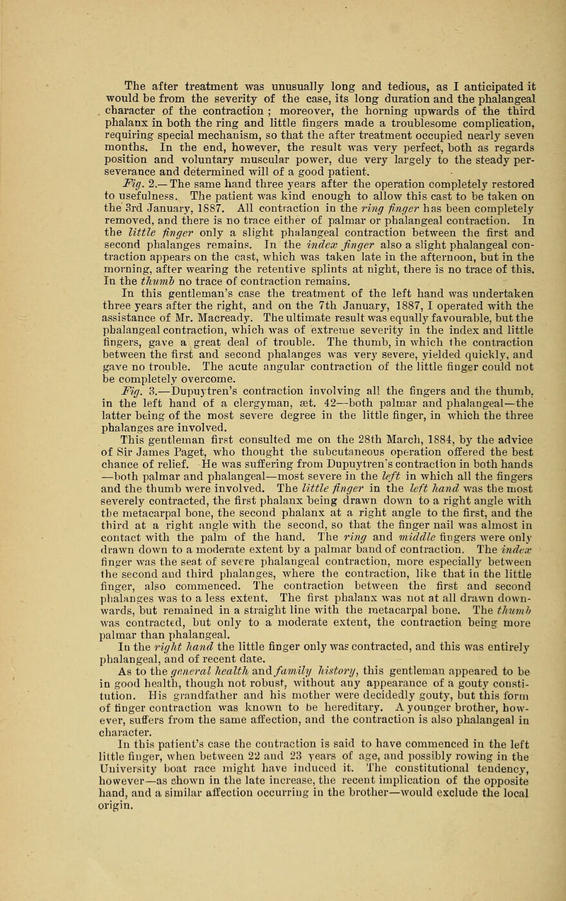 The after treatment was unusually long and tedious, as I anticipated it would be from the severity of the case, its long duration and the phalangeal character of the contraction ; moreover, the horning upwards of the third phalanx in both the ring and little fingers made a troublesome complication, requiring special mechanism, so that the after treatment occupied nearly seven months. In the end, however, the result was very perfect, both as regards position and voluntary muscular power, due very largely to the steady per- severance and determined will of a good patient. Fig. 2.— The same hand three years after the operation completely restored to usefulness. The patient was kind enough to allow this cast to be taken on the 3rd January, 1887. All contraction in the ring finger has been completely removed, and there is no trace either of palmar or phalangeal contraction. In the little finger only a slight phalangeal contraction between the first and second phalanges remains. In the index finger also a slight phalangeal con- traction appears on the cast, which was taken late in the afternoon, but in the morning, after wearing the retentive splints at night, there is no trace of this. In the thumb no trace of contraction remains. In this gentleman's case the treatment of the left hand was undertaken three years after the right, and on the 7th January, 1887, I operated with the assistance of Mr. Macready. The ultimate result was equally favourable, but the phalangeal contraction, which Avas of extreme severity in the index and little fingers, gave a great deal of trouble. The thumb, in which the contraction between the first and second jshalanges was very severe, yielded quickly, and gave no trouble. The acute angular contraction of the little finger could not be completely overcome. Fig. 3.—Dupujtren's contraction involving all the fingers and the thumb. in the left hand of a clergyman, s&i. 42—both palmar and phalangeal—the latter being of the most severe degree in the little finger, in which the three phalanges are involved. This gentleman first consulted me on the 28th March, 1884, by the advice of Sir James Paget, who thought the subcutaneous operation offered the best chance of relief. He was suffering from Dupuytrens contraction in both hands —both palmar and phalangeal—most severe in the left in which all the fingers and the thumb were involved. The little finger in the left liand was the most severely contracted, the first phalanx being drawn down to a right angle Avith the metacarpal bone, the second phalanx at a right angle to the first, and the third at a right angle with the second, so that the finger nail was almost in contact with the palm of the hand. The ri7ig and middle fingers were only drawn down to a moderate extent by a palmar band of contraction. The index finger was the seat of severe phalangeal contraction, more especiallj^ between the second and third phalanges, where the contraction, like that in the little finger, also commenced. The contraction between the first and second phalanges was to a less extent. The first phalanx was not at all drawn down- wards, but remained in a straight line with the metacarpal bone. The thumb was contracted, but only to a moderate extent, the contraction being more palmar than phalangeal. In the right hand the little finger only was contracted, and this was entirel}'^ phalangeal, and of recent date. As to the general health and family history, this gentleman appeared to be in good health, though not robust, without any appearance of a gouty consti- tution. His grandfather and his mother were decidedly gouty, but this form of finger contraction was known to be hereditary. A younger brother, how- ever, suffers from the same affection, and the contraction is also phalangeal in character. In this patient's case the contraction is said to have commenced in the left little finger, when between 22 and 23 years of age, and possibly rowing in the University boat race might have induced it. The constitutional tendency, however—as shown in the late increase, the recent implication of the opposite hand, and a similar affection occurring in the brother—would exclude the local origin.
