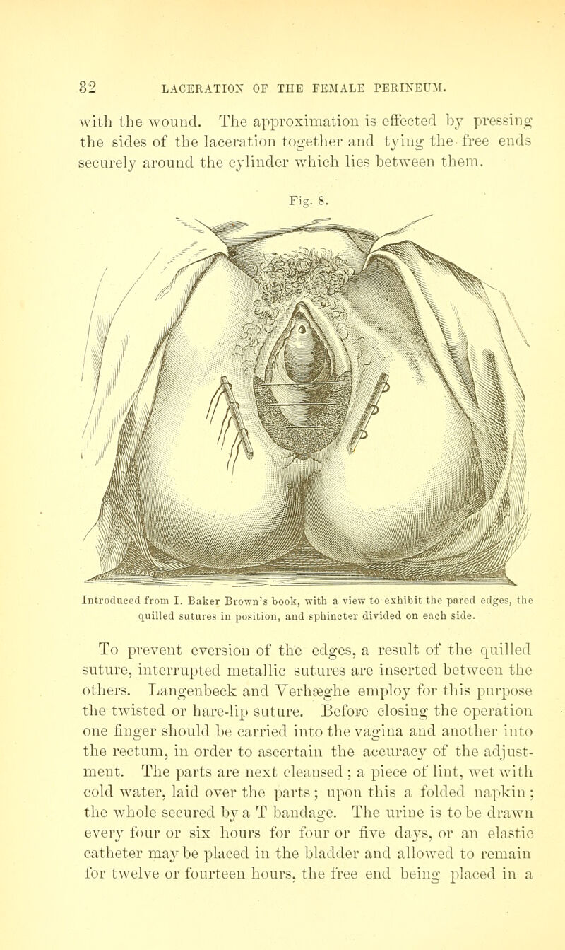 with the wound. The approximation is effected by pressing the sides of the laceration together and tying the- free ends securely around the cylinder which lies between them. Fie. 8. Introduced from I. Baker Brown's book, with a view to exhibit the pared edges, the quilled sutures in position, and sphincter divided on each side. To prevent eversion of the edges, a result of the quilled suture, interrupted metallic sutures are inserted between the others. Langenbeck and Verhseghe employ for this purpose the twisted or hare-lip suture. Before closing the operation one finger should be carried into the vagina and another into the rectum, in order to ascertain the accuracy of the adjust- ment. The parts are next cleansed ; a piece of lint, wet with cold water, laid over the parts; upon this a folded napkin; the whole secured by a T bandage. The urine is to be drawn every four or six hours for four or five days, or an elastic catheter maybe placed in the bladder and allowed to remain for twelve or fourteen hours, the free end being placed in a