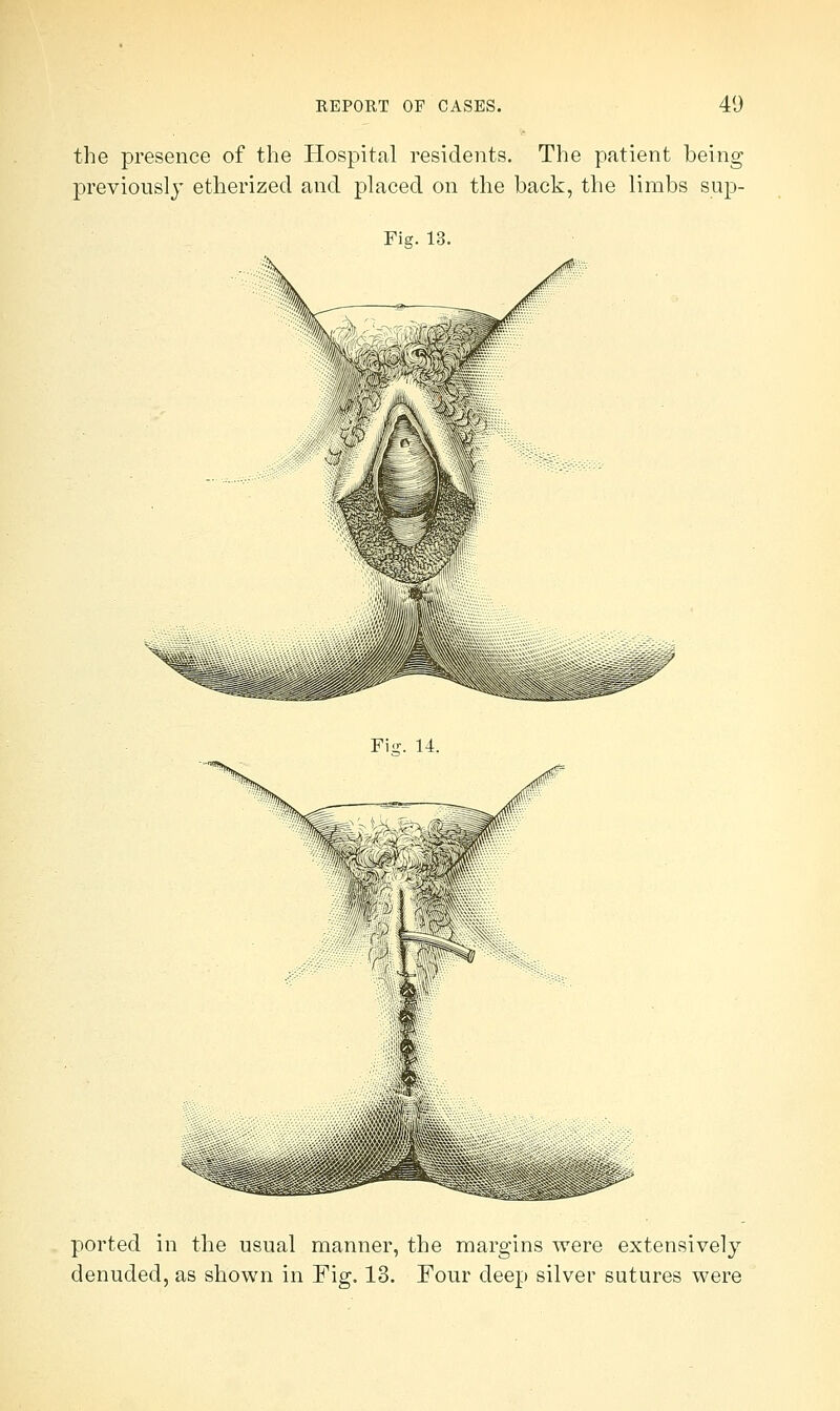 the presence of the Hospital residents. The patient being previously etherized and placed on the back, the limbs sup- Fig. 13. Fisr. 14. ported in the usual manner, the margins were extensively denuded, as shown in Fig. 13. Four deep silver sutures were