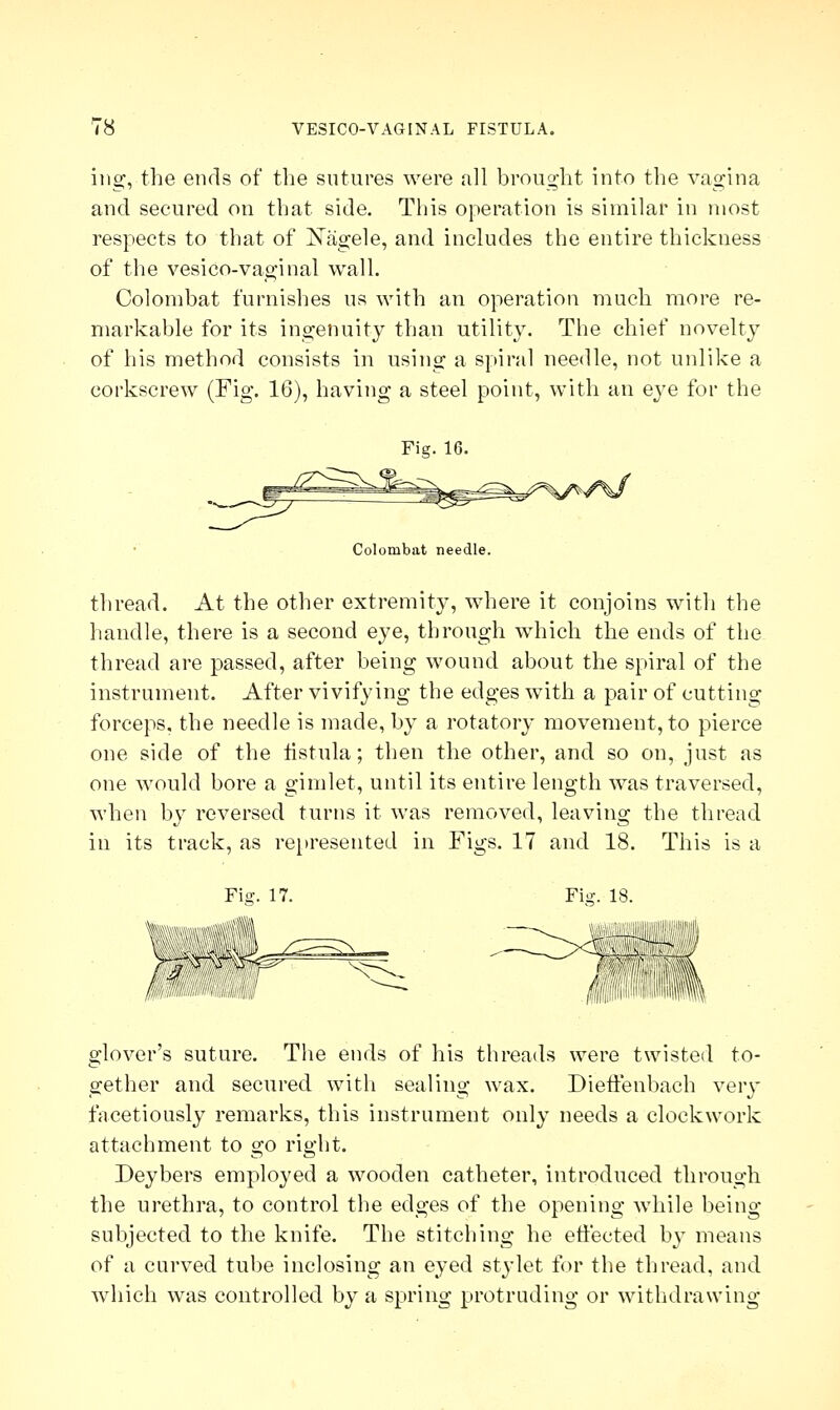 ing, the ends of the sutures were all brought into the vagina and secured on that side. This operation is similar in most respects to that of Xagele, and includes the entire thickness of the vesiCo-vaginal wall. Colombat furnishes us with an operation much more re- markable for its ingenuity than utility. The chief novelty of his method consists in using a spiral needle, not unlike a corkscrew (Fig. 16), having a steel point, with an eye for the Fig. 16. Colombat needle. thread. At the other extremity, where it conjoins with the handle, there is a second eye, through which the ends of the thread are passed, after being wound about the spiral of the instrument. After vivifying the edges with a pair of cutting forceps, the needle is made, by a rotatory movement, to pierce one side of the fistula; then the other, and so on, just as one would bore a gimlet, until its entire length was traversed, when by reversed turns it was removed, leaving the thread in its track, as represented in Figs. 17 and 18. This is a Fie. 17. Fig. 18. glover's suture. The ends of his threads were twisted to- gether and secured with sealing wax. Dieffenbach very facetiously remarks, this instrument only needs a clockwork attachment to go right. Deybers employed a wooden catheter, introduced through the urethra, to control the edges of the opening while being- subjected to the knife. The stitching he effected by means of a curved tube inclosing an eyed stylet for the thread, and which was controlled by a spring protruding or withdrawing