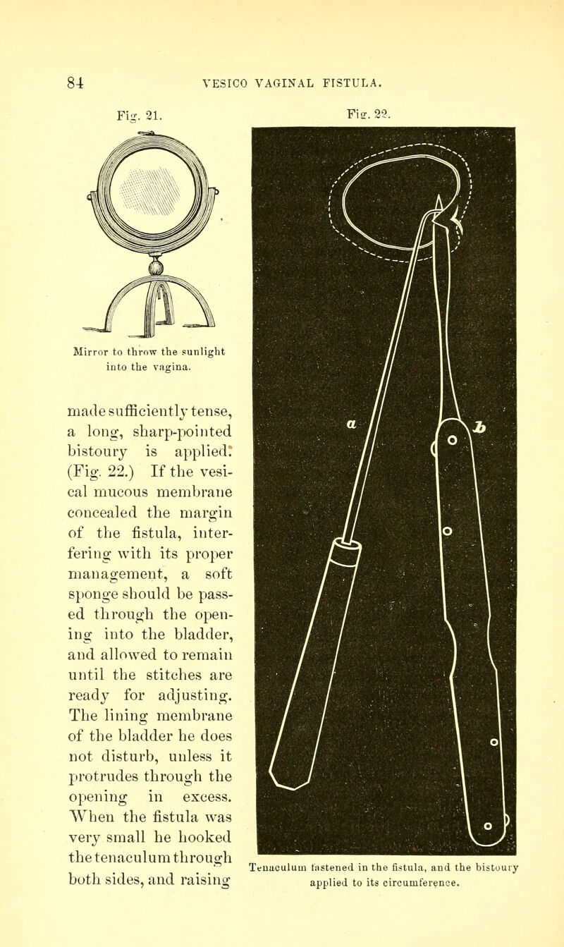 Fisr. 21. Fie. 2?. Mirror to throw the sunlight into the vagina. made sufficiently tense, a long, sharp-pointed bistoury is applied! (Fig. 22.) If the vesi- cal mucous membrane concealed the margin of the fistula, inter- fering with its proper management, a soft sponge should be pass- ed through the open- ing into the bladder, and allowed to remain until the stitches are ready for adjusting. The lining membrane of the bladder he does not disturb, unless it protrudes through the opening in excess. When the fistula was very small he hooked the tenaculum through both sides, and raising Tenaculum fastened in the fistula, and the bistoury applied to its circumference.