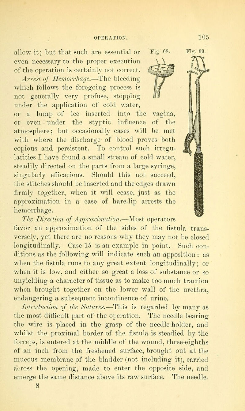 allow it; but that such are essential or even necessary to the proper execution of the operation is certainly not correct. Arrest of Hemorrhage.—The bleeding which follows the foregoing process is not generally very profuse, stopping under the application of cold water, or a lump of ice inserted into the or even under the styptic influence atmosphere; but occasionally cases will with where the discharge of blood proves Fist. 09. vagina, of the be met both copious and persistent. To control such irregu- larities I have found a small stream of cold water, steadily directed on the parts from a large syringe, singularly efficacious. Should this not succeed, the stitches should be inserted and the edges drawn firmly together, when it will cease, just as the approximation in a case of hare-lip arrests the hemorrhage. The Direction of Approximation.—Most operators favor an approximation of the sides of the fistula trans- versely, yet there are no reasons why they may not be closed longitudinally. Case 15 is an example in point. Such con- ditions as the following will indicate such an apposition: as when the fistula runs to any great extent longitudinally; or when it is low, and either so great a loss of substance or so unyielding a character of tissue as to make too much traction when brought together on the lower wall of the urethra, endangering a subsequent incontinence of urine. Introduction of the Sutures.—This is regarded by many as the most difficult part of the operation. The needle bearing the wire is placed in the grasp of the needle-holder, and whilst the proximal border of the fistula is steadied by the forceps, is entered at the middle of the wound, three-eighths of an inch from the freshened surface, brought out at the mucous membrane of the bladder (not including it), carried across the opening, made to enter the opposite side, and emerge the same distance above its raw surface. The needle-