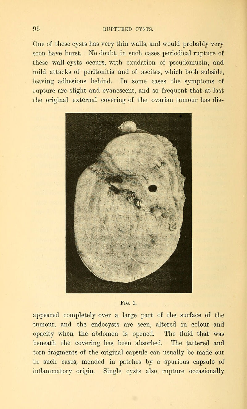 One of these cysts has very thin walls, and would probably very soon have burst. No doubt, in such cases periodical rupture of these wall-cysts occurs, with exudation of pseudomucin, and mild attacks of peritonitis and of ascites, which both subside, leaving adhesions behind. In some cases the symptoms of rupture are slight and evanescent, and so frequent that at last the original external coverinsf of the ovarian tumour has dis- FlG. 1. appeared completely over a large part of the surface of the tumour, and the endocysts are seen, altered in colour and opacity when the abdomen is opened. The fluid that was beneath the covering has been absorbed. The tattered and torn fragments of the original capsule can usually be made out in such cases, mended in patches by a spurious capsule of inflammatory origin. Single cysts also rupture occasionally