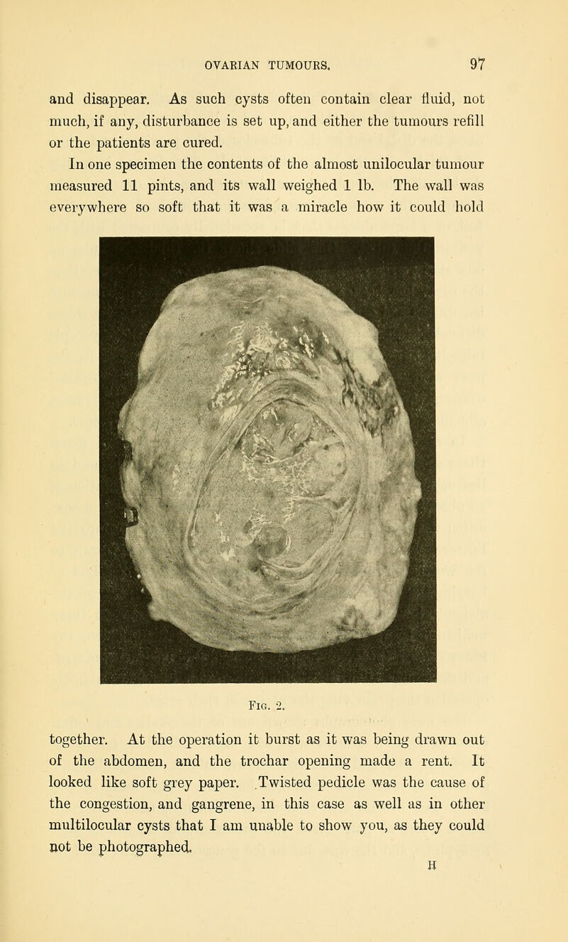 and disappear. As such cysts often contain clear fluid, not much, if any, disturbance is set up, and either the tumours refill or the patients are cured. In one specimen the contents of the almost unilocular tumour measured 11 pints, and its wall weighed 1 lb. The wall was everywhere so soft that it was a miracle how it could hold Fig. 2. together. At the operation it burst as it was being drawn out of the abdomen, and the trochar opening made a rent. It looked like soft grey paper. Twisted pedicle was the cause of the congestion, and gangrene, in this case as well as in other multilocular cysts that I am unable to show you, as they could cot be photographed.