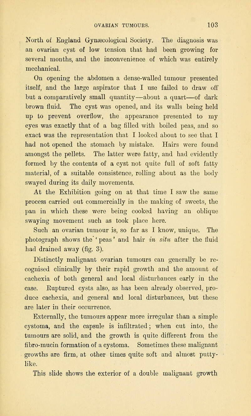 North of England Gynaecological Society. The diagnosis was an ovarian cyst of low tension that had been growing for several months, and the inconvenience of which was entirely mechanical. On opening the abdomen a dense-walled tumour presented itself, and the large aspirator that I use failed to draw off but a comparatively small quantity—about a quart—of dark brown fluid. The cyst was opened, and its walls being held up to prevent overflow, the appearance presented to my eyes was exactly that of a bag filled with boiled peas, and so exact was the representation that I looked about to see that I had not opened the stomach by mistake. Hairs were found amongst the pellets. The latter were fatty, and had evidently formed by the contents of a cyst not quite full of soft fatty material, of a suitable consistence, rolling about as the body swayed during its daily movements. At the Exhibition going on at that time I saw the same process carried out commercially in the making of sweets, the pan in which these were being cooked having an oblique swaying movement such as took place here. Such an ovarian tumour is, so far as I know, unique. The photograph shows the'' peas' and hair in situ after the fluid had drained away (fig. 3). Distinctly malignant ovarian tumours can generally be re- cognised clinically by their rapid growth and the amount of cachexia of both general and local disturbances early in the case. Euptured cysts also, as has been already observed, pro- duce cachexia, and general and local disturbances, but these are later in their occurrence. Externally, the tumours appear more irregular than a simple cystoma, and the capsule is infiltrated; when cut into, the tumours are solid, and the growth is quite different from the fibro-mucin formation of a cystoma. Sometimes these malignant growths are firm, at other times quite soft and almost putty- like. This slide shows the exterior of a double malignant growth