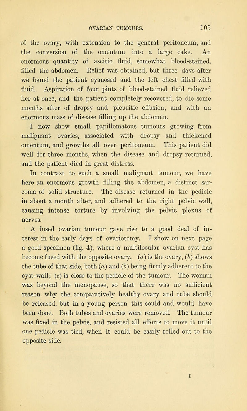 of the ovary, with extension to the general peritoneum, and the conversion of the omentum into a large cake. An enormous quantity of ascitic fluid, somewhat blood-stained, filled the abdomen. Belief was obtained, but three days after we found the patient cyanosed and the left chest filled with fluid. Aspiration of four pints of blood-stained fluid relieved her at once, and the patient completely recovered, to die some months after of dropsy and pleuritic effusion, and with an enormous mass of disease filling up the abdomen. I now show small papillomatous tumours growing from malignant ovaries, associated with dropsy and thickened omentum, and growths all over peritoneum. This patient did well for three months, when the disease and dropsy returned, and the patient died in great distress. In contrast to such a small malignant tumour, we have here an enormous growth filling the abdomen, a distinct sar- coma of solid structure. The disease returned in the pedicle in about a month after, and adhered to the right pelvic wall, causing intense torture by involving the pelvic plexus of nerves. A fused ovarian tumour gave rise to a good deal of in- terest in the early days of ovariotomy. I show on next page a good specimen (fig. 4), where a multilocular ovarian cyst has become fused with the opposite ovary, {a) is the ovary, (h) shows the tube of that side, both {a) and (h) being firmly adherent to the cyst-wall; (c) is close to the pedicle of the tumour. The woman was beyond the menopause, so that there was no sufficient reason why the comparatively healthy ovary and tube should be released, but in a young person this could and would have been done. Both tubes and ovaries were removed. The tumour was fixed in the pelvis, and resisted all efforts to move it until one pedicle was tied, when it could be easily rolled out to the opposite side.