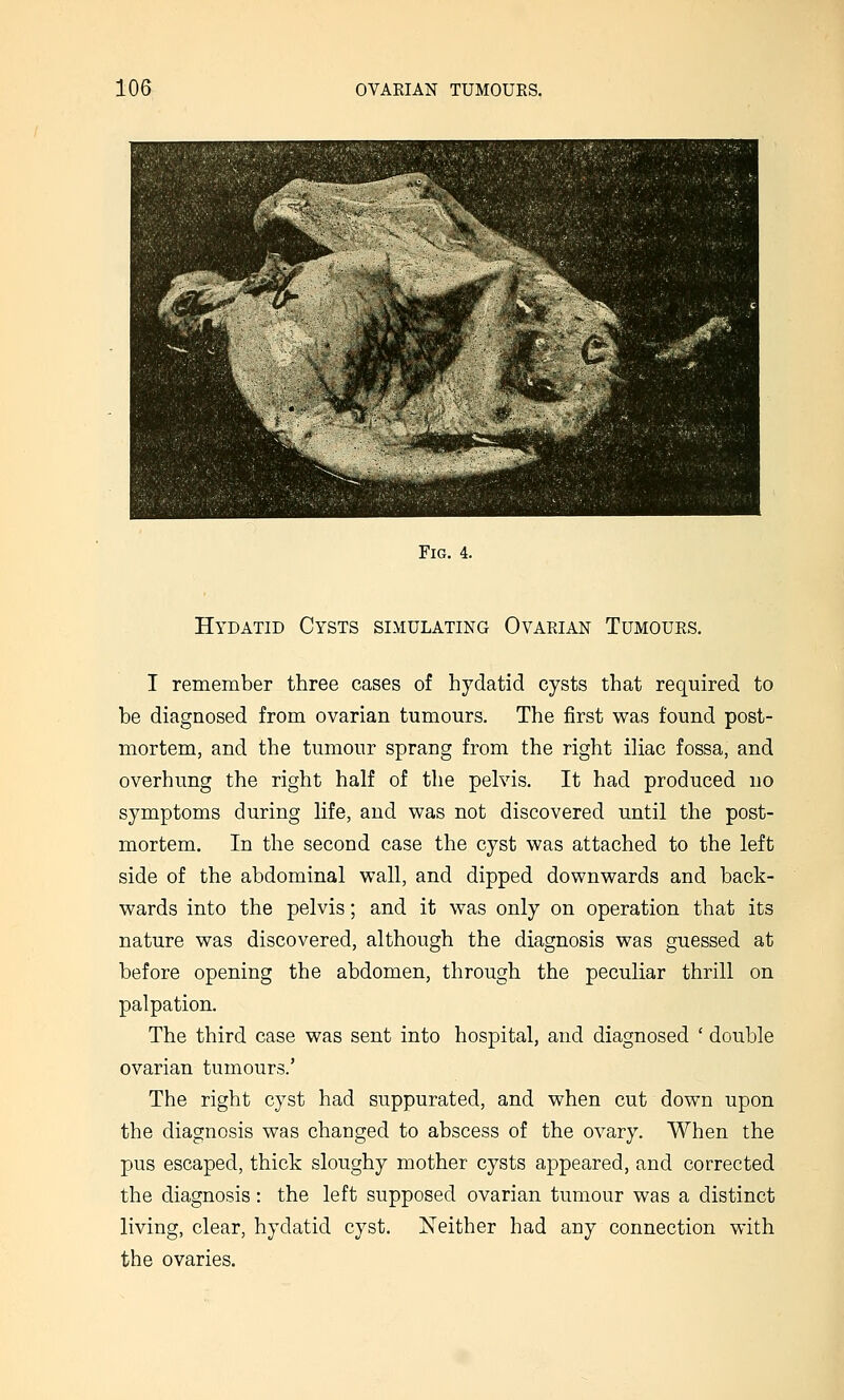 Fig. 4. Hydatid Cysts simulating Ovarian Tumours. I remember three cases of hydatid cysts that required to be diagnosed from ovarian tumours. The first was found post- mortem, and the tumour sprang from the right iliac fossa, and overhung the right half of the pelvis. It had produced no symptoms during life, and was not discovered until the post- mortem. In the second case the cyst was attached to the left side of the abdominal wall, and dipped downwards and back- wards into the pelvis; and it was only on operation that its nature was discovered, although the diagnosis was guessed at before opening the abdomen, through the peculiar thrill on palpation. The third case was sent into hospital, and diagnosed ' double ovarian tumours.' The right cyst had suppurated, and when cut down upon the diagnosis was changed to abscess of the ovary. When the pus escaped, thick sloughy mother cysts appeared, and corrected the diagnosis: the left supposed ovarian tumour was a distinct living, clear, hydatid cyst. Neither had any connection with the ovaries.