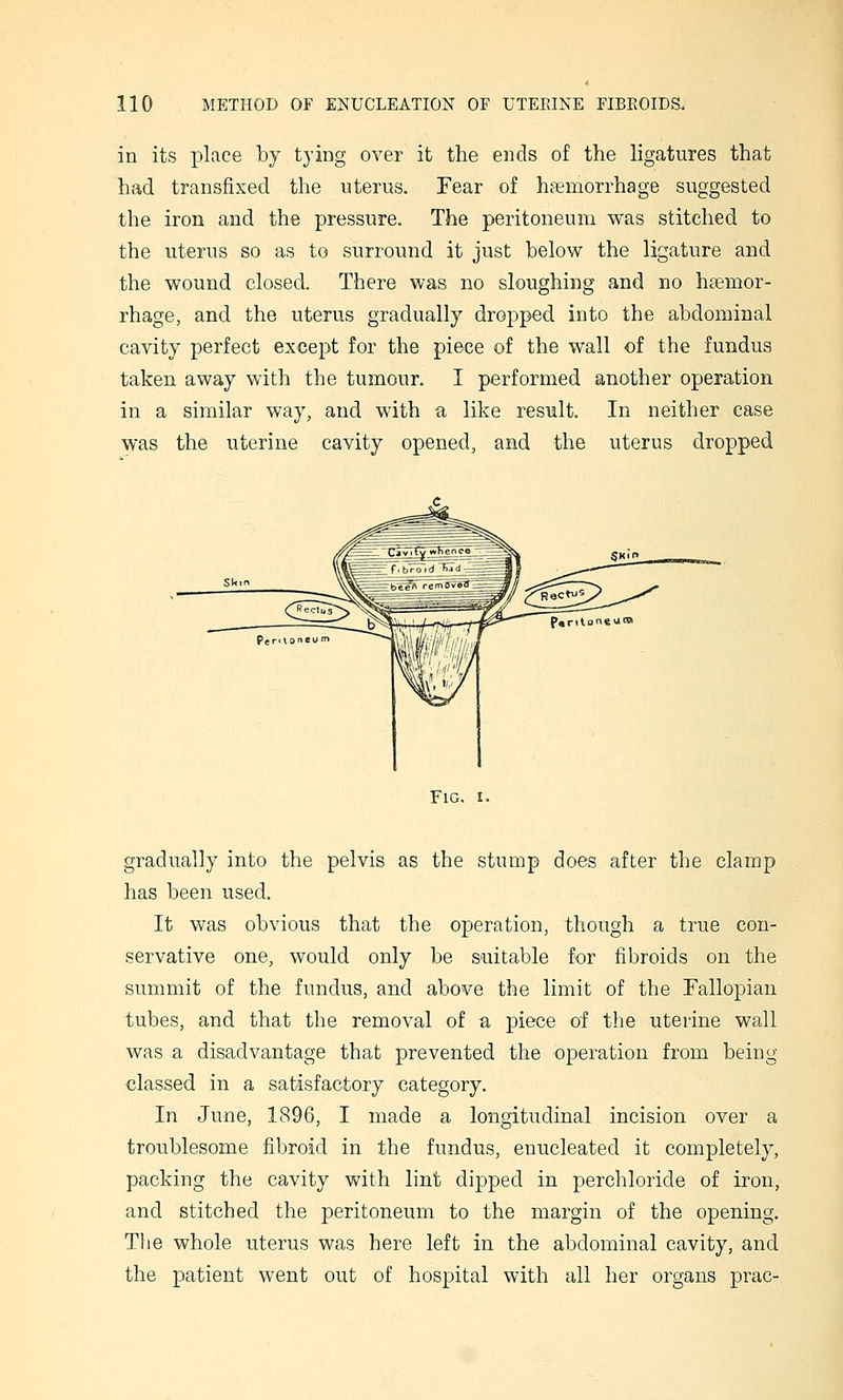 in its place by tying over it the ends of the ligatures that had transfixed the nterus. Fear of haemorrhage suggested the iron and the pressure. The peritoneum was stitched to the uterus so as to surround it just below the ligature and the wound closed. There was no sloughing and no haemor- rhage, and the uterus gradually dropped into the abdominal cavity perfect except for the piece of the wall of the fundus taken away with the tumour. I performed another operation in a similar way, and with a, like result. In neither case was the uterine cavity opened, and the uterus dropped Fig. I. gradually into the pelvis as the stump does after the clamp has been used. It was obvious that the operation, though a true con- servative one, would only be suitable for fibroids on the summit of the fundus, and above the limit of the Fallopian tubes, and that the removal of a piece of the uterine wall was a disadvantage that prevented the operation from being classed in a satisfactory category. In June, 1896, I made a longitudinal incision over a troublesome fibroid in the fundus, enucleated it completely, packing the cavity with lint dipped in perchloride of iron, and stitched the peritoneum to the margin of the opening. The whole uterus was here left in the abdominal cavity, and the patient went out of hospital with all her organs prac-