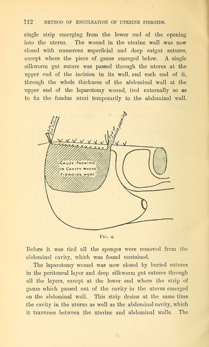 single strip emerging from the lower end of the opening into the uterus. The wound in the uterine wall was now closed with numerous superficial and deep catgut sutures, except where the piece of gauze emerged below. A single silkworm gut suture was passed through the uterus at the upper end of the incision in its wall, and each end of it, through the whole thickness of the abdominal wall at the upper end of the laparotomy wound, tied externally so as to fix the fundus uteri temporarily to the abdominal wall. Fig. 4- Before it was tied all the sponges were removed from the abdominal cavity, which was found unstained. The laparotomy wound was now closed by buried sutures in the peritoneal layer and deep silkworm gut sutures through all the layers, except at the lower end where the strip of gauze which passed out of the cavity in the uterus emerged on the abdominal wall. This strip drains at the same time the cavity in the uterus as well as the abdominal cavity, which it traverses between the uterine and abdominal walls. The
