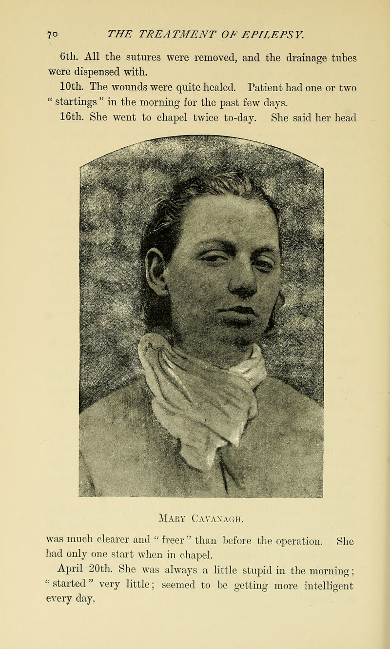 ?° 6th. All the sutures were removed, and the drainage tubes were dispensed with. 10th. The wounds were quite healed. Patient had one or two  startmgs  in the morning for the past few days. 16th. She went to chapel twice to-day. She said her head Mary Cavanagh. was much clearer and  freer  than before the operation. She had only one start when in chapel. April 20th. She was always a little stupid in the morning; '•'started very little; seemed to be getting more intelligent every day.