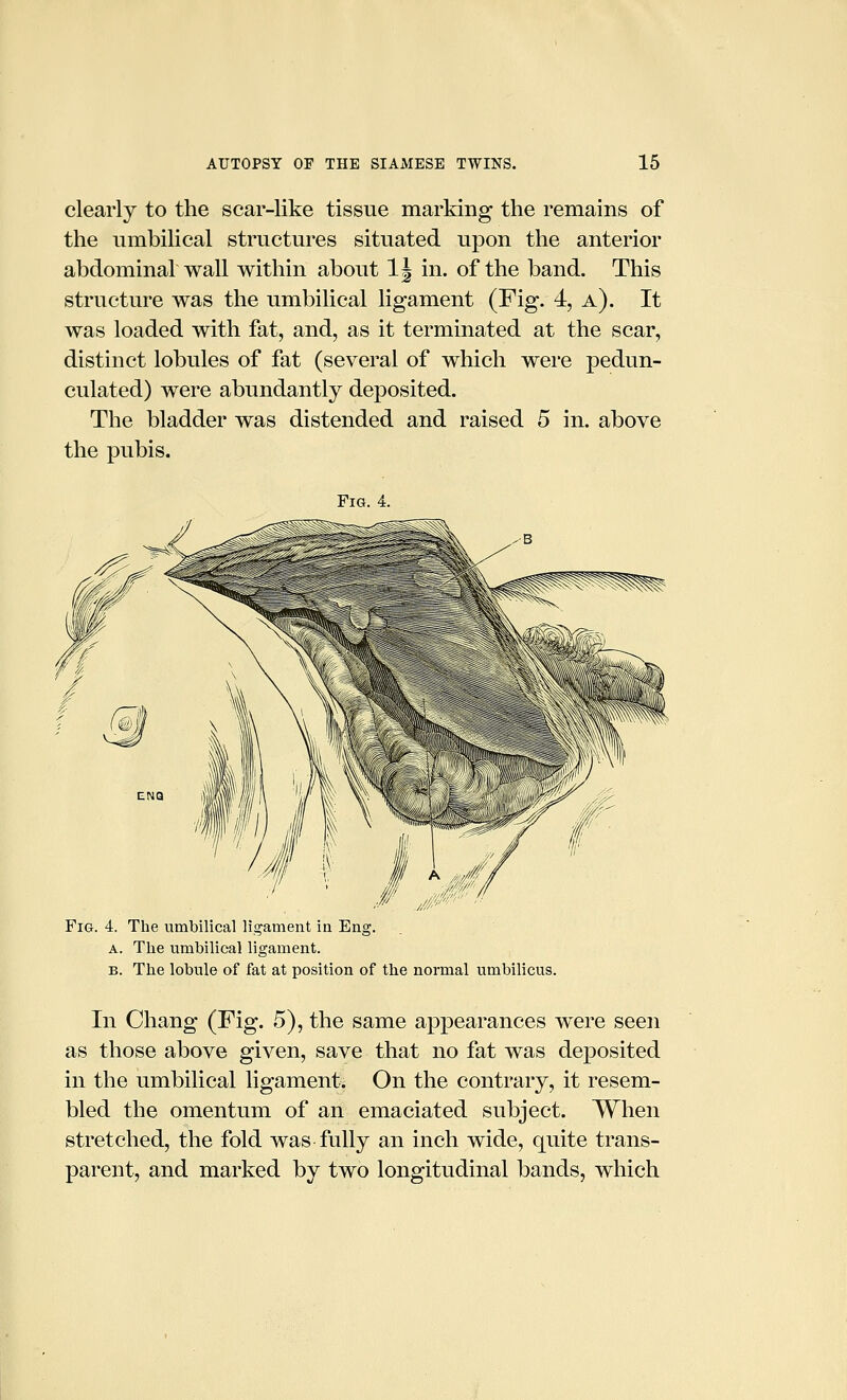 clearly to the scar-like tissue marking the remains of the nmbilical structures situated upon the anterior abdominar wall within about IJ in. of the band. This structure was the umbilical ligament (Fig. 4, a). It was loaded with fat, and, as it terminated at the scar, distinct lobules of fat (several of which were pedun- culated) were abundantly deposited. The bladder was distended and raised 5 in. above the pubis. Fig. 4. The umbilical ligament in Eng. A. The umbilical ligament. B. The lobule of fat at position of the normal umbilicus. In Chang (Fig. 5), the same appearances were seen as those above given, save that no fat was deposited in the umbilical ligament. On the contrary, it resem- bled the omentum of an emaciated subject. When stretched, the fold was fully an inch wide, quite trans- parent, and marked by two longitudinal bands, which