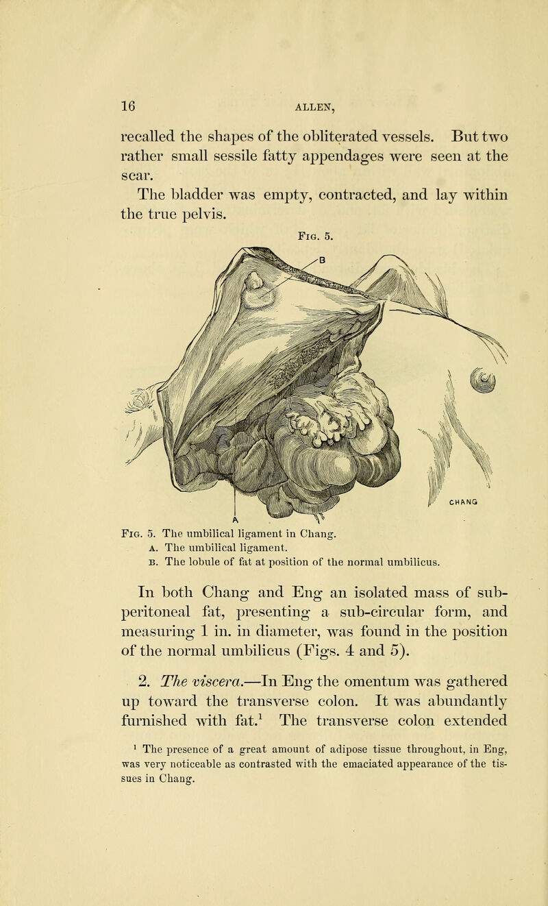 recalled the shapes of the obliterated vessels. But two rather small sessile fatty appendages were seen at the scar. The bladder was empty, contracted, and lay within the true pelvis. Fig. 5. ^ r^v^'A Fig. 5. The umbilical ligament in Chang. A. The mnbilical ligament. B. The lobule of fat at position of the normal umbilicus. In both Chang and Eng an isolated mass of sub- peritoneal fat, presenting a sub-circular form, and measuring 1 in. in diameter, was found in the position of the normal umbilicus (Figs. 4 and 5). 2. The viscera.—In Eng the omentum was gathered up toward the transverse colon. It was abundantly furnished with fat.^ The transverse colon extended • The presence of a great amount of adipose tissue throughout, in Eng, was very noticeable as contrasted with the emaciated appearance of the tis- sues in Chang.