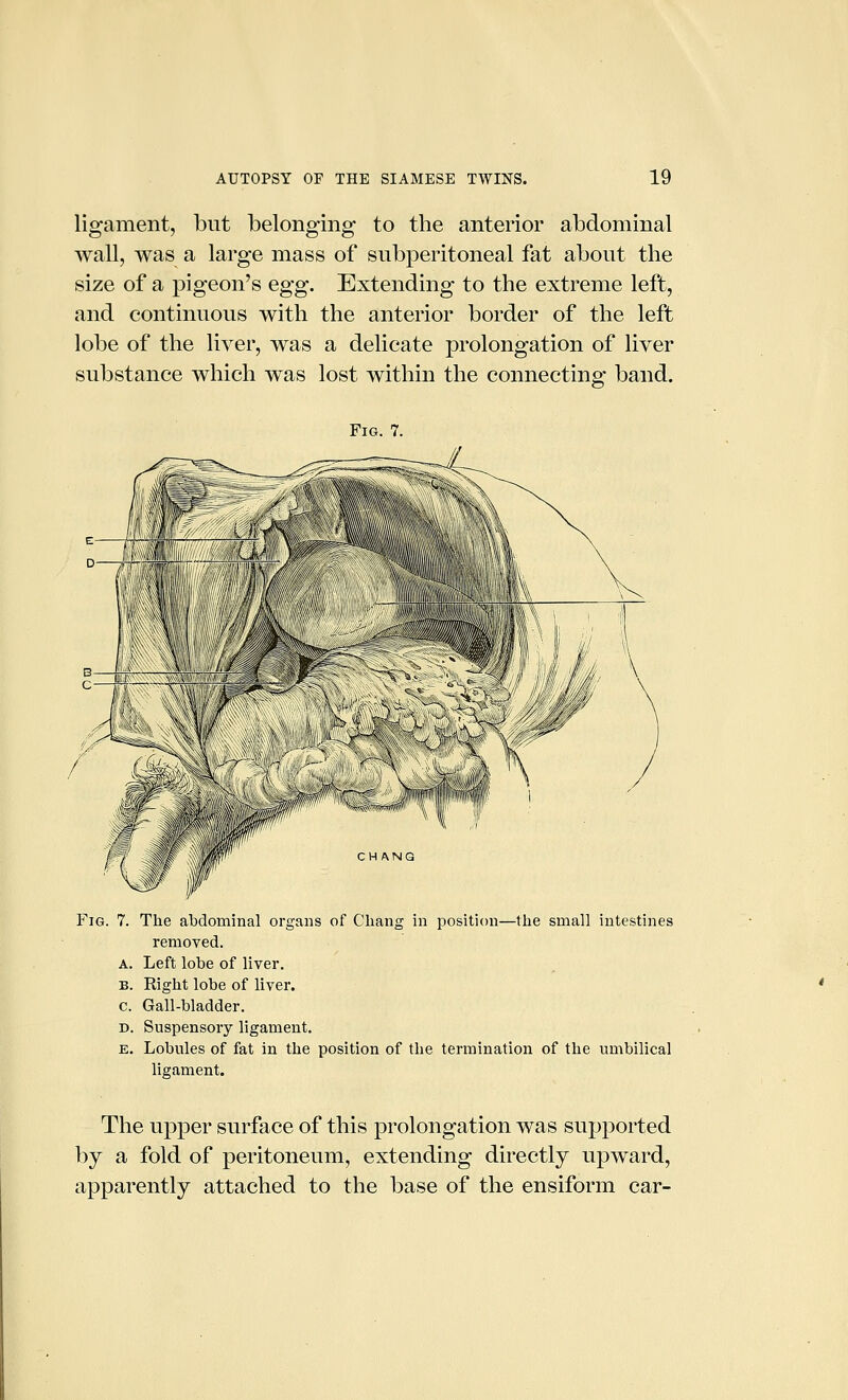 ligament, but belonging to the anterior abdominal wall, was a large mass of subperitoneal fat about the size of a pigeon's egg. Extending to the extreme left, and continuous with the anterior border of the left lobe of the liver, was a delicate prolongation of liver substance which was lost within the connecting band. Fig. 7. Fig. 7. The abdominal organs of Chang in position—the small intestines removed. A. Left lobe of liver. B. Right lobe of liver. c. Gall-bladder. D. Suspensory ligament. E. Lobules of fat in the position of the termination of the umbilical ligament. The upper surface of this prolongation was supported by a fold of peritoneum, extending directly upward, apparently attached to the base of the ensiform car-