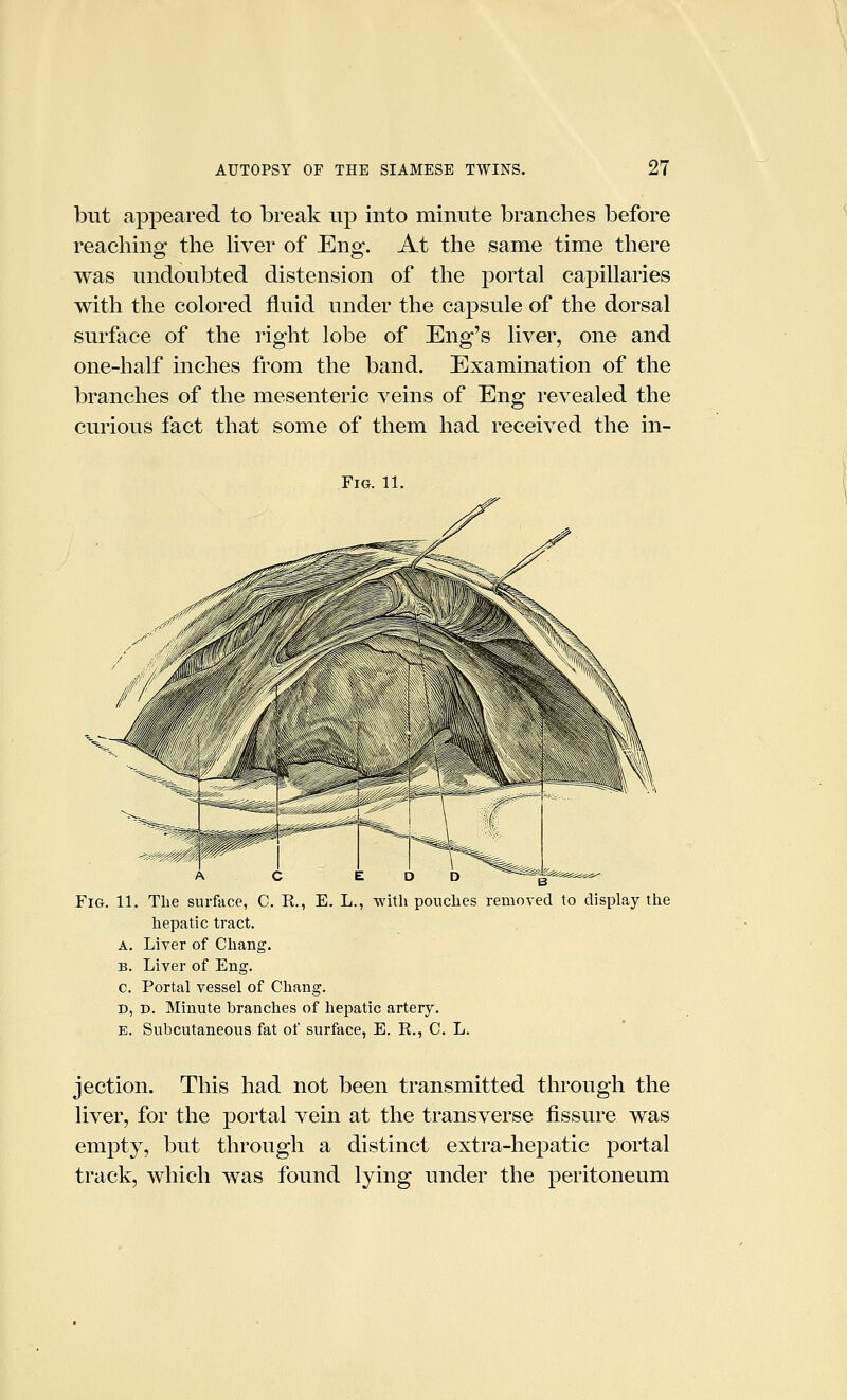 but appeared to break up into minute branches before reaching the liver of Eng. At the same time there was undoubted distension of the portal capillaries with the colored fluid under the capsule of the dorsal surface of the right lobe of Eng's liver, one and one-half inches from the band. Examination of the branches of the mesenteric veins of Eng revealed the curious fact that some of them had received the in- FlG. 11. A C E D D ^ Fig. 11. The surface, C. R., E. L., with pouches removed to display the hepatic tract. A. Liver of Chang. B. Liver of Eng. c. Portal vessel of Chang. D, D. Minute branches of hepatic artery. E. Subcutaneous fat of surface, E. R., C. L. jection. This had not been transmitted through the liver, for the portal vein at the transverse fissure was empty, but through a distinct extra-hepatic portal track, which was found lying under the peritoneum