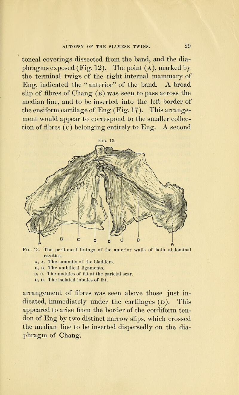 toneal coverings dissected from the band, and the dia- phragms exposed (Fig. 12). The point (a), marked by the terminal twigs of the right internal mammary of Eng, indicated the anterior of the band. A broad slip of fibres of Chang (b) was seen to pass across the median line, and to be inserted into the left border of the ensiform cartilage of Eng (Fig. 17). This arrange- ment would appear to correspond to the smaller collec- tion of fibres (c) belonging entirely to Eng. A second Fig. 13. Fig. 13. The peritoneal linings of the anterior walls of both abdominal cavities. A, A. The summits of the bladders. B, B. The umbilical ligaments. c, c. The nodules of fat at the parietal scar. D, D. The isolated lobules of fat. arrangement of fibres was seen above those just in- dicated, immediately under the cartilages (d). This appeared to arise from the border of the cordiform ten- don of Eng by two distinct narrow slips, which crossed the median line to be inserted dispersedly on the dia- phragm of Chang.