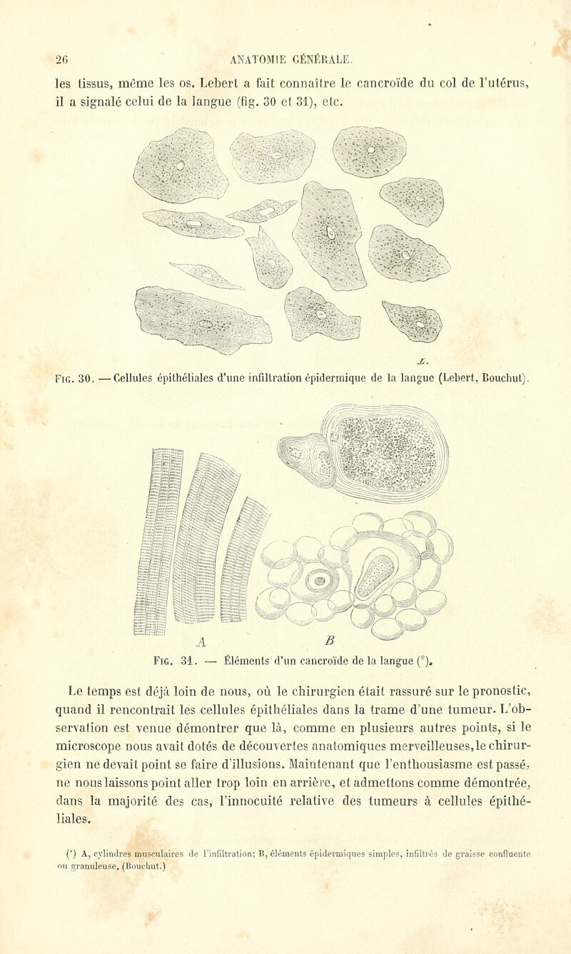 les tissus, mCme les os. Lebert a fait connaître le cancroïde du col de l'utérus, il a signalé celui de la langue (fig. 30 et 31), etc. (■ ) Fig. 30. —Cellules épithéliales d'une infiltration épidermique de la langue (Lebert, Bouchut). 5 -f / / .1 B Fig. 31. — Éléments d'un cancroïde de la langue (*)* Le temps est déjà loin de nous, où le chirurgien était rassuré sur le pronostic, quand il rencontrait les cellules épithéliales dans la trame d'une tumeur. L'ob- servation est venue démontrer que là, comme en plusieurs autres points, si le microscope nous avait dotés de découvertes anatomiques merveilleuses,le chirur- gien ne devait point se faire d'illusions. Maintenant que l'enthousiasme est passé, ne nous laissons point aller trop loin en arrière, et admettons comme démontrée, dans la majorité des cas, l'innocuité relative des tumeurs à cellules épithé- liales. (*) A, cj'lindres musculaires de l'infiltralion; B, éléments épidermiques simples, infiltrés dégraisse confluente ou granuleuse. (Bouelmt.)