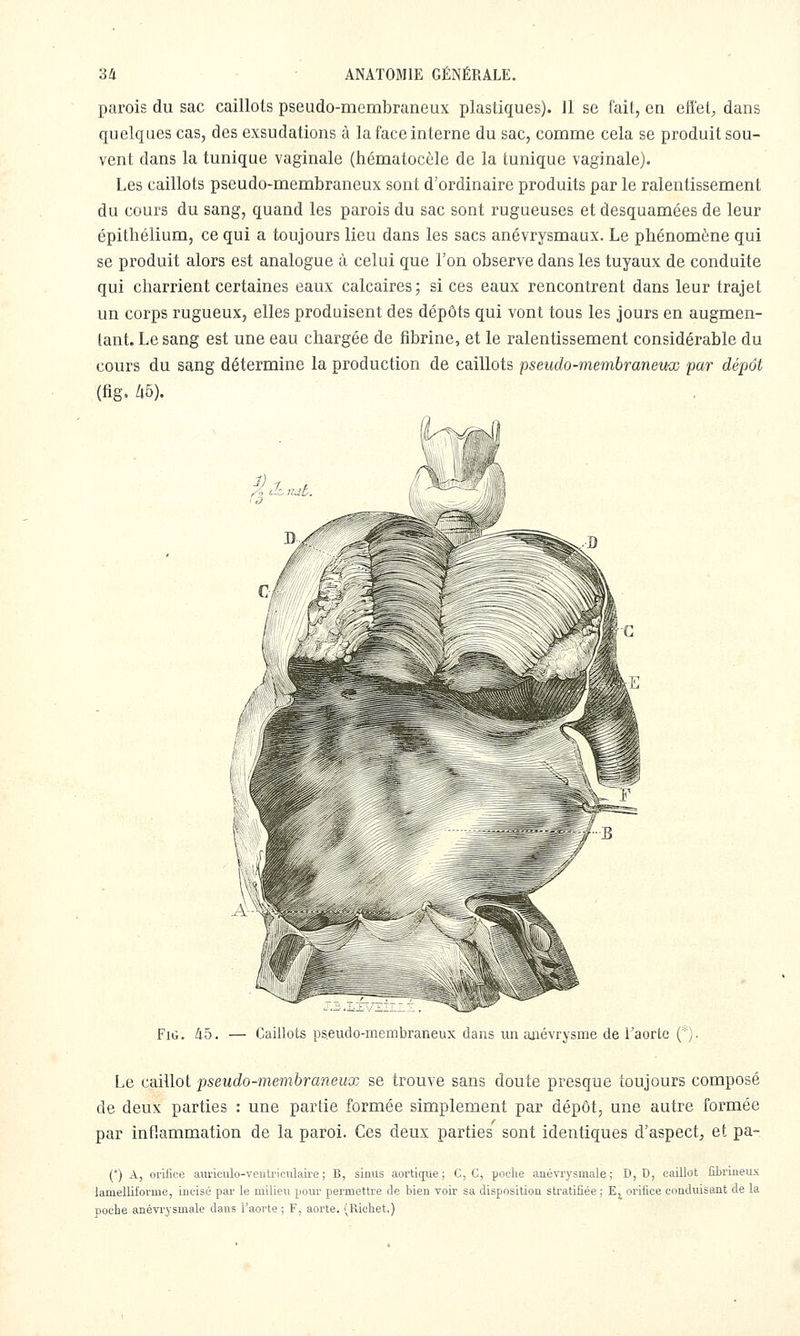 parois du sac caillots pseudo-membraneux plastiques). 11 se fait, en effet, dans quelques cas, des exsudations à la face interne du sac, comme cela se produit sou- vent dans la tunique vaginale (hématocèle de la tunique vaginale). Les caillots pseudo-membraneux sont d'ordinaire produits par le ralentissement du cours du sang, quand les parois du sac sont rugueuses et desquamées de leur épitliélium, ce qui a toujours lieu dans les sacs anévrysmaux. Le phénomène qui se produit alors est analogue à celui que l'on observe dans les tuyaux de conduite qui charrient certaines eaux calcaires; si ces eaux rencontrent dans leur trajet un corps rugueux, elles produisent des dépôts qui vont tous les jours en augmen- tant. Le sang est une eau chargée de fibrine, et le ralentissement considérable du cours du sang détermine la production de caillots pseudo-membraneux par dépôt (fig. ^6). FiG. 45. — Caillots ps.eudo-membraneux dans un anévrysme de Faorte ('). Le caillot pseudo-membraneux se trouve sans doute presque toujours composé de deux parties : une partie formée simplement par dépôt, une autre formée par inflammation de la paroi. Ces deux parties sont identiques d'aspect, et pa- (*) A, orifice aiiriculo-ventriculaire ; B, sinUs aorticpie; C, C, poclie anévrysmale; D, D, caillot fibriueus lamelliforme, incisé par le milieu pour permettre de bien voir sa disposition stratifiée ; E^ orifice conduisant de la pocbe anévrysmale dans l'aorte ; F, aorte. (Richet.)