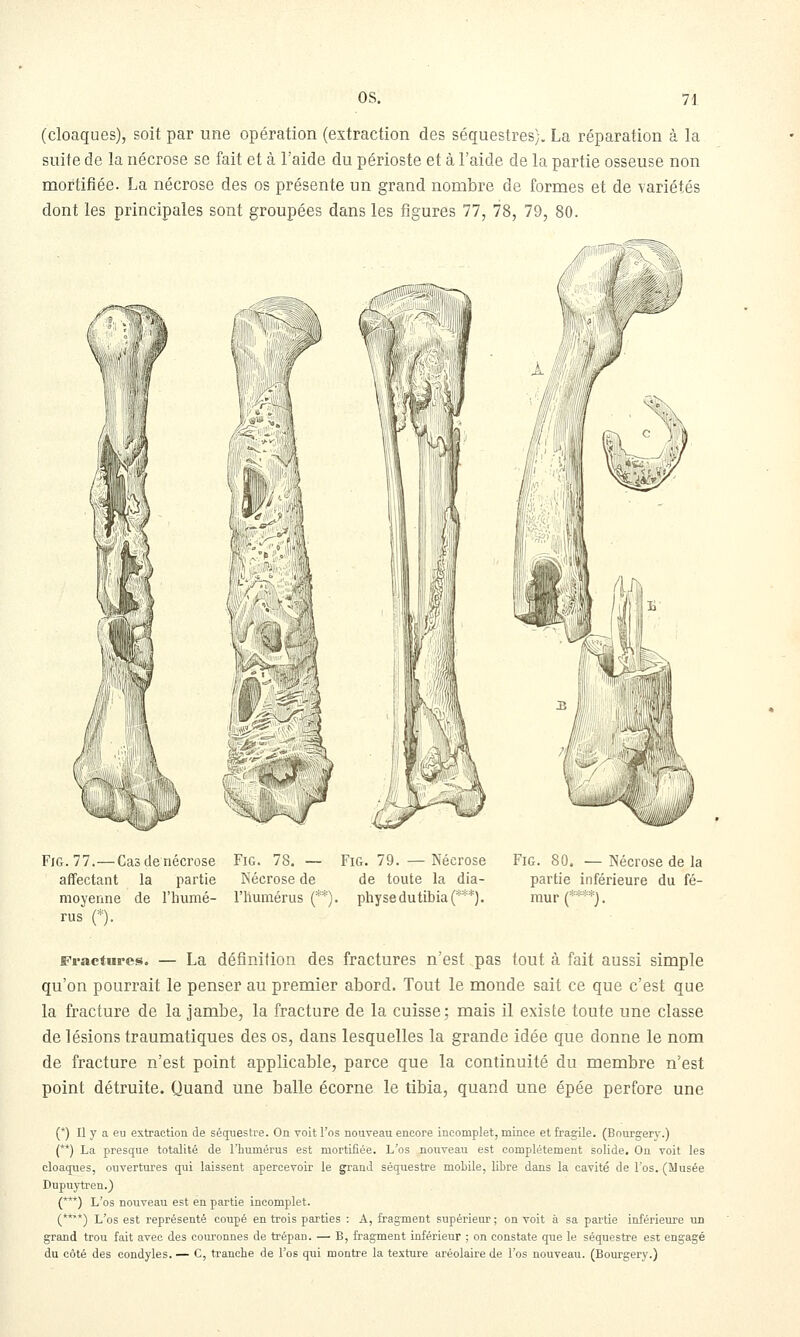 (cloaques), soit par une opération (extraction des séquestres). La réparation à la suite de la nécrose se fait et à l'aide du périoste et à l'aide de la partie osseuse non mortifiée. La nécrose des os présente un grand nombre de formes et de variétés dont les principales sont groupées dans les figures 77, 78, 79, 80. FiG. 77.—Cas de nécrose affectant la partie moyenne de l'inimé- rus (*). FiG. 78. — Nécrose de riiuraérus (* FiG. 79. — Nécrose de toute la dia- . physedutibia (***). FiG. 80. — Nécrose de la partie inférieure du fé- mur C^'***). Fractures. — La définition des fractures n'est pas tout à fait aussi simple qu'on pourrait le penser au premier abord. Tout le monde sait ce que c'est que la fracture de la jambe, la fracture de la cuisse: mais il existe toute une classe de lésions traumatiques des os, dans lesquelles la grande idée que donne le nom de fracture n'est point applicable, parce que la continuité du membre n'est point détruite. Quand une balle écorne le tibia, quand une épée perfore une (*) Il y a eu extraction de séquesti-e. On voit l'os nouveau encore incomplet, mince et fragile. (Bourgery.) (**) La presque totalité de l'humérus est mortifiée. L'os nouveau est complètement solide. On voit les cloaques, ouvertures qui laissent apercevoir le grand séquestre mobile, libre dans la cavité de l'os. (IMusée Dupuytren.) (***) L'os nouveau est en partie incomplet. (***) L'os est représenté coupé en trois parties : A, fragment supérieur ; on voit à sa partie inférieure un grand trou fait avec des couronnes de trépan. — B, fragment inférieur ; on constate que le séquestre est engagé du côté des condyles. — C, tranche de l'os qui montre la texture aréolaire de l'os nouveau. (Bourgery.)