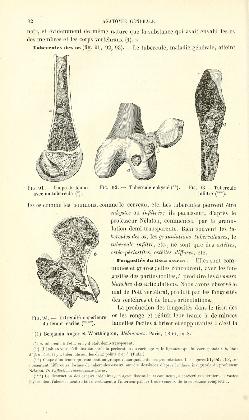 noir, et évidcmmcnL de même nature que la substance qui avait envahi les os des membres et les corps vertébraux (1). » Tuiici-ciBics des os (fig. 91, 92, 93). — Le tubercule, maladie générale, atteint l'iG. 91. — Coupe du fémur avec un tubercule (*). Fig. 92.— Tubercule enkysté Fig. 93. —Tuliercule infiltré ('='•'). les OS comme les poumons, comme le cerveau, etc. Les tubercules peuvent être enkystés ou infiltrés; ils paraissent, d'après le professeur Nélaton, commencer par la granu- lation demi-transparente. Bien souvent les tu- bercules des os, les granulations tuberculeuses, le tubercule infiltré, etc., ne sont que des ostéites, ostéo-périostites, ostéites diffuses, etc. Fongositésdu tsssa osscais. — Elles sont com- munes et graves ; elles concourent, avec les fon- gosités des parties molles, à produire les tumeurs blanches des articulations. Nous avons observé le mal de Pott vertébral, produit par les fongosités des vertèbres et de leurs articulations. La production des fongosités dans le tissu des os les ronge et réduit leur trame à de minces lamelles faciles à briser et suppurantes : c'est la (1) Benjamin Anger et Worthington, Mélanomes. Paris, 1866, in-8. (*) «, tubercule à l'état cru ; il était demi-transparent. (**) Il était en voie d'élimination après la perforation du cai'tilage a; le ligament qui lui correspondait, h, était déjà ulcéré. Il y a tubercule sur les deux points a et b. (Rufz.) (***) Coupe d'un fémur qui contenait uu groupe remarquable de ces granulations. Les figm'es 91, 92 et 93, re- présentant différentes formes de tubercules osseux, ont été dessinées d'après la thèse inaugurale du professeur Nélaton, De l'affection tuberculeuse des os. ('*'*) La destruction des canaux aréolaires, en agrandissant leurs confluents, a converti ces derniers en vastes loyers, dont l'abouchement se fait directement à l'intérieur par les trous veineux de la substance compacte a. Fig. 94. — Extrémité supérieure du fémur cariée (****).