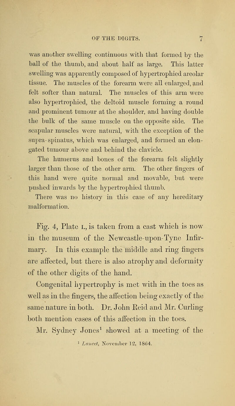 was another swelling continuous with that formed by the ball of the thumb, and about half as large. This latter swelling was apparently composed of hypertrophied areolar tissue. The muscles of the forearm were all enlarged, and felt softer than natural. The muscles of this arm were also hypertrophied, the deltoid muscle forming a round and prominent tumour at the shoulder, and having double the bulk of the same muscle on the opposite side. The scapular muscles were natural, with the exception of the supra-spinatus, which was enlarged, and formed an elon- gated tumour above and behind the clavicle. The humerus and bones of the forearm felt slightly larger than those of the other arm. The other fingers of this hand were quite normal and movable, but were pushed inwards by the hypertrophied thumb. There was no history in this case of any hereditary malformation. Fig. 4, Plate L, is taken from a cast which is now in the museum of the Newcastle-upon-Tyne Infir- mary. In this example the middle and ring fingers are affected, but there is also atrophy and deformity of the other digits of the hand. Congenital hypertrophy is met with in the toes as well as in the fingers, the affection being exactly of the same nature in both. Dr. John Eeid and Mr. Curling both mention cases of this affection in the toes. Mr. Sydney Jones1 showed at a meeting of the 1 Lancet, November 12, 1864.