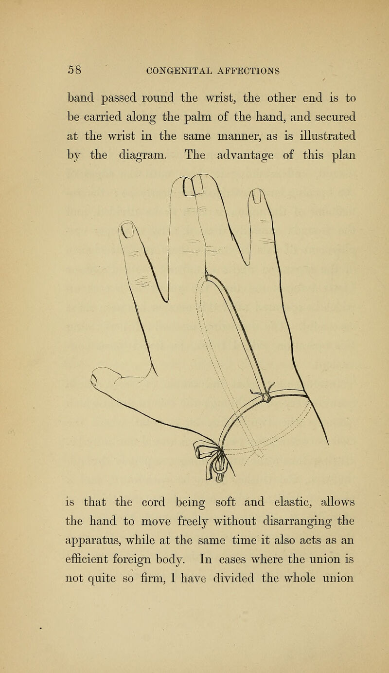 band passed round the wrist, the other end is to be carried along the palm of the hand, and secured at the wrist in the same manner, as is illustrated by the diagram. The advantage of this plan is that the cord being soft and elastic, allows the hand to move freely without disarranging the apparatus, while at the same time it also acts as an efficient foreign body. In cases where the union is not quite so firm, I have divided the whole union