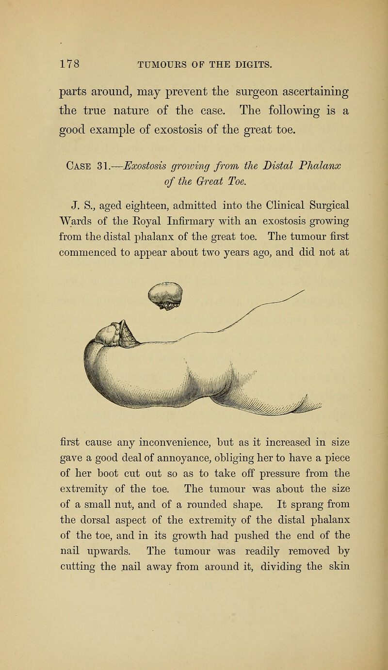 parts around, may prevent the surgeon ascertaining the true nature of the case. The following is a good example of exostosis of the great toe. Case 31.—Exostosis growing from the Distal Phalanx of the Great Toe. J. S., aged eighteen, admitted into the Clinical Surgical Wards of the Eoyal Infirmary with an exostosis growing from the distal phalanx of the great toe. The tumour first commenced to appear about two years ago, and did not at first cause any inconvenience, but as it increased in size gave a good deal of annoyance, obliging her to have a piece of her boot cut out so as to take off pressure from the extremity of the toe. The tumour was about the size of a small nut, and of a rounded shape. It sprang from the dorsal aspect of the extremity of the distal phalanx of the toe, and in its growth had pushed the end of the nail upwards. The tumour was readily removed by cutting the nail away from, around it, dividing the skin