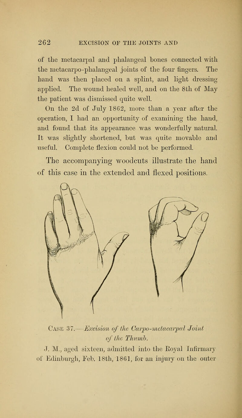 of the metacarpal and phalangeal hones connected with the metacarpophalangeal joints of the four fingers. The hand was then placed on a splint, and light dressing- applied. The wound healed well, and on the 8th of May the patient was dismissed quite well. On the 2d of July 1862, more than a year after the operation, I had an opportunity of examining the hand, and found that its appearance was wonderfully natural. It was slightly shortened, but was cpiite movable and useful. Complete flexion could not be performed. The accompanying woodcuts illustrate the hand of this case in the extended and flexed positions. Case 37.—Excision of the Ccwpo-mdacavpal Joint of the Thumb. J. M., aged sixteen, admitted into the Roj-al Infirmary of Edinburgh, Feb. 18th, 1861, for an injury on the outer