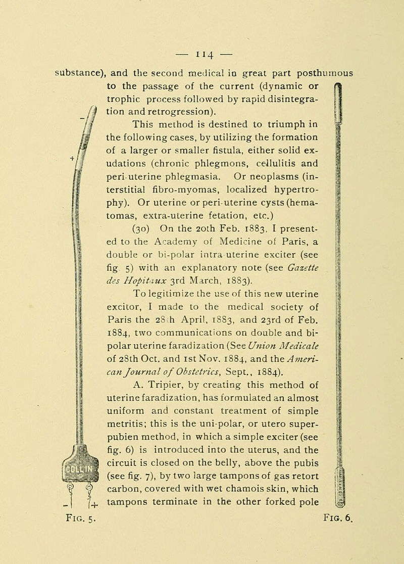 substance), and the second medical in great part posthumous to the passage of the current (dynamic or jfj trophic process followed by rapid disintegra- tion and retrogression). This method is destined to triumph in the following cases, by utilizing the formation of a larger or smaller fistula, either solid ex- udations (chronic phlegmons, cellulitis and peri uterine phlegmasia. Or neoplasms (in- terstitial fibro-myomas, localized hypertro- phy). Or uterine or peri-uterine cysts (hema- tomas, extra-uterine fetation, etc.) (30) On the 20th Feb. 1883, I present- ed to the Academy of Medicine of Paris, a double or bi-polar intrauterine exciter (see fig 5) with an explanatory note (see Gazette des Hopitaux 3rd March, 1883). To legitimize the use of this new uterine excitor, I made to the medical society of Paris the 28;h April, 1883, and 23rd of Feb. 1884, two communications on double and bi- polar uterine faradization (See Union Medicale of 28th Oct. and 1st Nov. 1884, and the Ameri- can Journal of Obstetrics, Sept., 1884). A. Tripier, by creating this method of uterine faradization, has formulated an almost uniform and constant treatment of simple metritis; this is the unipolar, or utero super- pubien method, in which a simple exciter (see fig. 6) is introduced into the uterus, and the circuit is closed on the belly, above the pubis (see fig. 7), by two large tampons of gas retort carbon, covered with wet chamois skin, which tampons terminate in the other forked pole Fig. 5. Fig. 6.