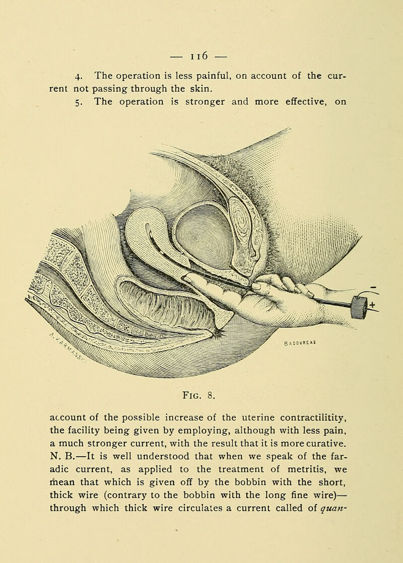4. The operation is less painful, on account of the cur- rent not passing through the skin. 5. The operation is stronger and more effective, on Fig. 8. account of the possible increase of the uterine contractilitity, the facility being given by employing, although with less pain, a much stronger current, with the result that it is more curative. N. B.—It is well understood that when we speak of the far- adic current, as applied to the treatment of metritis, we mean that which is given off by the bobbin with the short, thick wire (contrary to the bobbin with the long fine wire)— through which thick wire circulates a current called of quan-