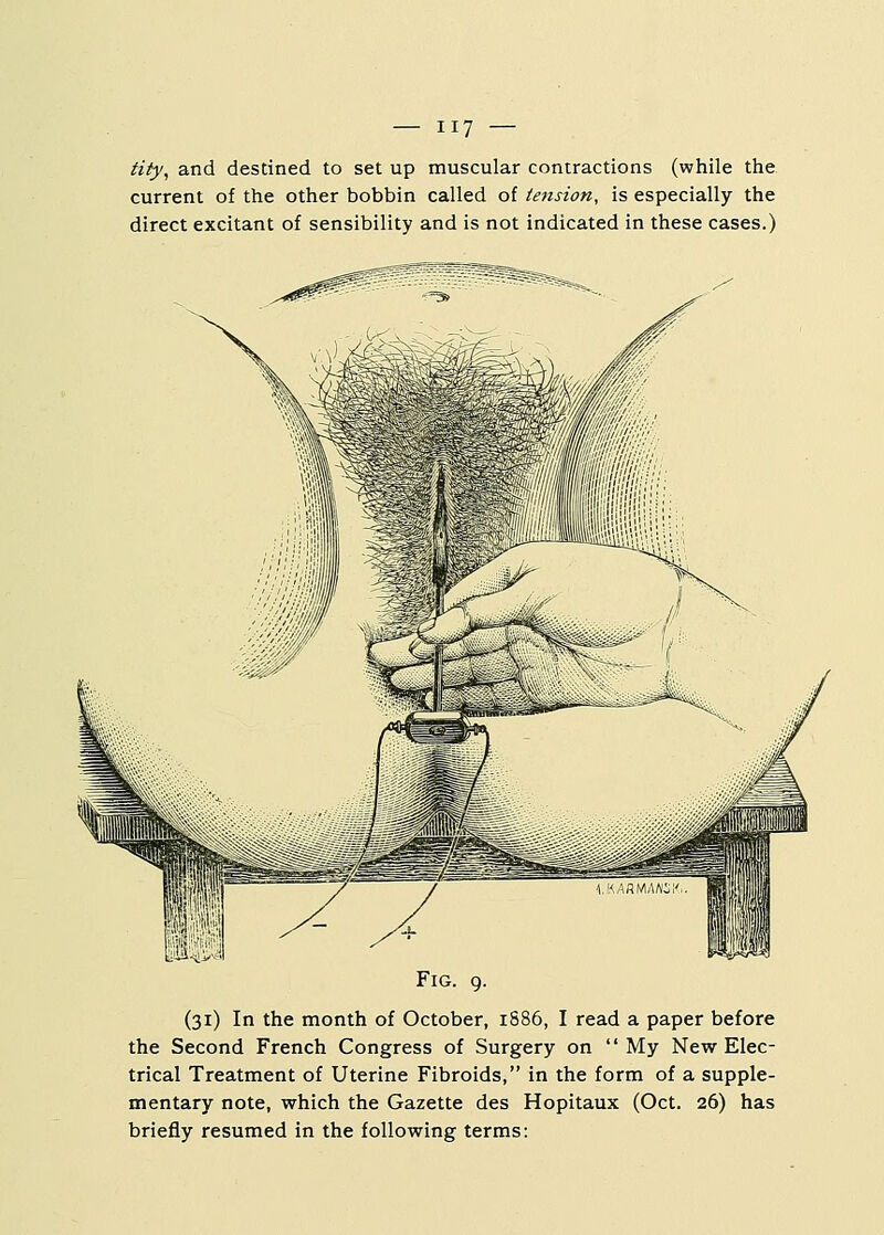 tity, and destined to set up muscular contractions (while the current of the other bobbin called of tension, is especially the direct excitant of sensibility and is not indicated in these cases.) Fig. 9. (31) In the month of October, 1886, I read a paper before the Second French Congress of Surgery on My New Elec- trical Treatment of Uterine Fibroids, in the form of a supple- mentary note, which the Gazette des Hopitaux (Oct. 26) has briefly resumed in the following terms: