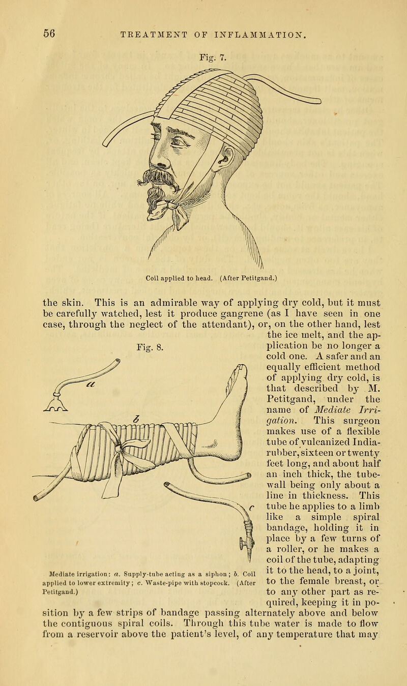Fi-. 7. Coil applied to head. (After Petitgand.) the skin. This is an admirable way of applying dry cold, but it must be carefully watched, lest it produce gangrene (as I have seen in one case, through the neglect of the attendant), or, on the other hand, lest the ice melt, and the ap- Fi^. 8. plication be no longer a cold one. A safer and an equally efficient method of applying dry cold, is that described by M. Petitgand, under the name of Mediate Irri- gation. This surgeon makes use of a flexible tube of vulcanized India- rubber, sixteen or twenty feet long, and about half an inch thick, the tube- wall being only about a line in thickness. This tube he applies to a limb like a simple spiral bandage, holding it in place by a few turns of a roller, or he makes a coil of the tube, adapting it to the head, to a joint, to the female breast, or to any other part as re- quired, keeping it in po- sition by a few strips of bandage passing alternately above and below the contiguous spiral coils. Through this tube water is made to flow from a reservoir above the patient's level, of any temperature that may Mediate irrigation: a. Supply-tube acting as a siphon; 6. Coil applied to lower extremity ; c. Waste-pipe with stopcouk. (After Petitgand.)