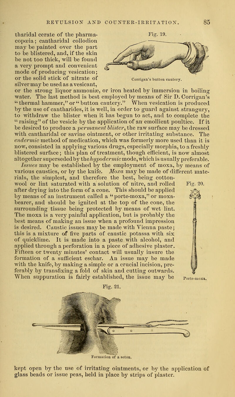 Corrigan's buttoa cautery. tharidal cerate of the pliarma- Fig. 19. copoeia: cantliaridal collodion may be painted over the part to be blistered, and, if the skin be not too thick, will be found a very prompt and convenient mode of producing vesication; or the solid stick of nitrate of silver may be used as a vesicant, or the strong liquor ammonite, or iron heated by immersion in boiling water. The last method is best employed by means of Sir D. Corrigan's  thermal hammer, or  button cautery. When vesication is produced by the use of cantharides, it is well, in order to guard against strangury, to withdraw the blister when it has begun to act, and to complete the  raising of the vesicle by the application of an emollient poultice. If it be desired to produce a permanent blister^ the raw surface may be dressed with cantharidal or savine ointment, or other irritating substance. The endermic method of medication, which was formerly more used than it is now, consisted in applying various drugs, especially morphia, to a freshly blistered surface; this plan of treatment, though efficient, is now almost altogether superseded by thehypodermic mode, which is usually preferable. Issues may be established by the employment of moxa, by means of various caustics, or by the knife. Moxa may be made of different mate- rials, the simplest, and therefore the best, being cotton- wool or lint saturated with a solution of nitre, and rolled Fig. 20. after drjdng into the form of a cone. This should be applied by means of an instrument called a porte-moxa, or moxa- bearer, and should be ignited at the top of the cone, the surrounding tissue being protected bj'' means of wet lint. The moxa is a very painful application, but is probably the best means of making an issue when a profound impression is desired. Caustic issues may be made with Vienna paste; this is a mixture of five parts of caustic potassa with six of quicklime. It is made into a paste with alcohol, and applied through a perforation in a piece of adhesive plaster. Fifteen or twenty minutes' contact will usually insure the formation of a sufficient eschar. An issue may be made with the knife, b}' making a simple or a crucial incision, pre- ferably by transfixing a fold of skin and cutting outwards. When suppuration is fairly established, the issue may be Poi-te-moxa. Fiff. 21. kept open by the use of irritating ointments, or by the application of glass beads or issue peas, held in place b}'^ strips of plaster.