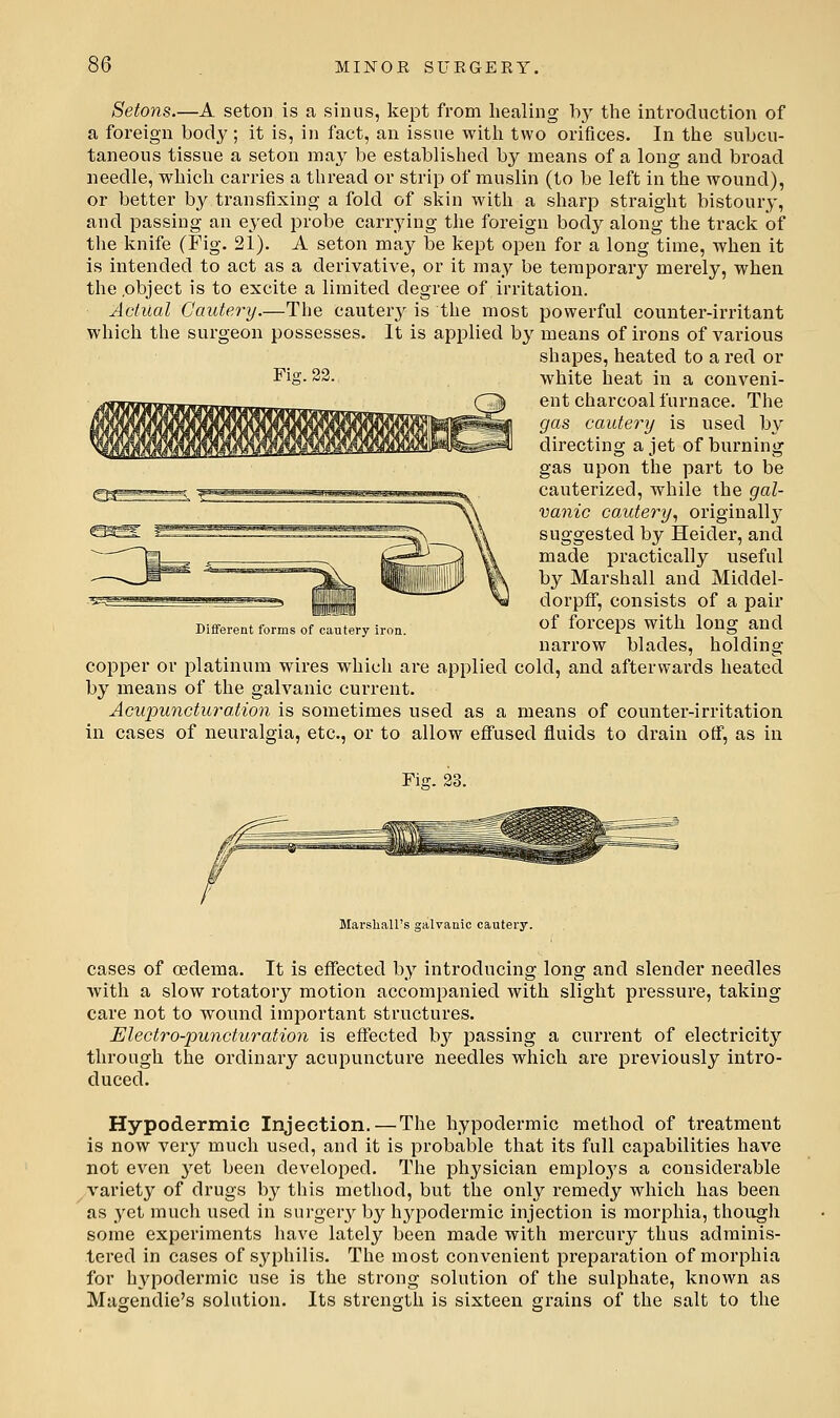 Setons.—A seton is a sinus, kept from healing by the introduction of a foreign body; it is, in fact, an issue with two orifices. In the subcu- taneous tissue a seton may be established by means of a long and broad needle, which carries a thread or strip of muslin (to be left in the wound), or better by transfixing a fold of skin with a sharp straight bistoury, and passing an eyed probe carrying the foreign body along the track of the knife (Fig. 21). A seton may be kept open for a long time, when it is intended to act as a derivative, or it may be temporary merely, when the .object is to excite a limited degree of irritation. Actual Cautery.—The cautery is the most powerful counter-irritant which the surgeon possesses. It is applied by means of irons of various shapes, heated to a red or Fig. 22. white heat in a conveni- ent charcoal furnace. The gas cauteiy is used by directing a jet of burning gas upon the part to be cauterized, while the gal- vanic cautery, originally suggested by Heider, and made practically useful by Marshall and Middel- dorpff, consists of a pair of forceps with long and narrow blades, holding- copper or platinum wires which are applied cold, and afterwards heated by means of the galvanic current. Acupuncturation is sometimes used as a means of counter-irritation in cases of neuralgia, etc., or to allow effused fluids to drain off, as in Different forms of cautery iron. Fiff. 23. Marshall's galvanic cautery. cases of oedema. It is effected by introducing long and slender needles with a slow rotatory motion accompanied with slight pressure, taking care not to wound important structures. Electro-puncturation is effected by passing a current of electricit}'' through the ordinary acupuncture needles which are previously intro- duced. Hypodermic Injection. — The hypodermic method of treatment is now very much used, and it is probable that its full capabilities have not even yet been developed. The physician employs a considerable variety of drugs by this method, but the only remedy which has been as yet much used in surgery by hypodermic injection is morphia, though some experiments have lately been made with mercury thus adminis- tered in cases of syphilis. The most convenient preparation of morphia for hj^podermic use is the strong solution of the sulphate, known as Masendie's solution. Its strength is sixteen grains of the salt to the