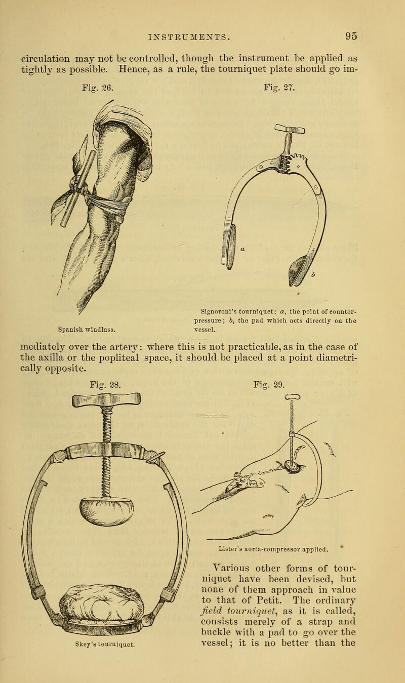 circulation may not be controlled, though the instrument be applied as tightly as possible. Hence, as a rule, the tourniquet plate should go im- Fig. 26. Fig. 27. Spanish windlass. Signoroni's tourniquet: a, the point of counter- pressure ; h, the pad which acts directly ou the vessel. mediately over the artery: where this is not practicable, as in the case of the axilla or the popliteal space, it should be placed at a point diametri- cally opposite. Fig. 28. Fig. 29. Skey's tourniquet. Lister's aorta-compressov applied. Various other forms of tour- niquet have been devised, but noue of them approach in value to that of Petit. The ordiuary field tourniquet^ as it is called, consists merely of a strap and buckle with a joad to go over the vessel: it is no better than the