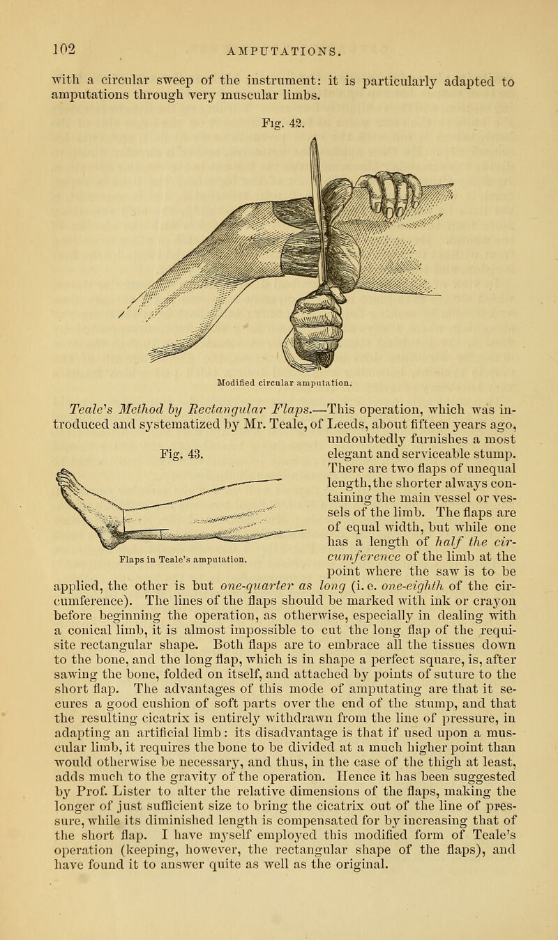 with a circular sweep of the instrument: it is particularly adapted to amputations through very muscular limbs. Fiff. 43. Modified circular amputation; Teale''s Method by Rectangular Flaps.—This operation, which was in- troduced and systematized by Mr. Teale, of Leeds, about fifteen years ago, undoubtedly furnishes a most Fig, 43. elegant and serviceable stump. There are two flaps of unequal length,the shorter always con- taining the main vessel or ves- sels of the limb. The flaps are of equal width, but while one has a length of half the cir- Fiaps iu Teaie's amputation. cum.ference of the limb at the point where the saw is to be applied, the other is but one-quarter as long (i.e. one-eighth of the cir- cumference). The lines of the flaj)S should be marked with ink or crayon before beginning the operation, as otherwise, especially in dealing with a conical limb, it is almost impossible to cut the long flap of the requi- site rectangular shape. Both flaps are to embrace all the tissues down to the bone, and the long flap, which is in shape a perfect square, is, after sawing the bone, folded on itself, and attached by points of suture to the short flap. The advantages of this mode of amputating are that it se- cures a good cushion of soft parts over the end of tlie stump, and that the resulting cicatrix is entirely withdrawn from the line of pressure, in adapting an artificial limb: its disadvantage is that if used upon a mus- ciilar limb, it requires the bone to be divided at a much higher point than would otherwise be necessary, and thus, in the case of the thigh at least, adds much to the graA'it}^ of the operation. Hence it has been suggested by Prof. Lister to alter the relative dimensions of the flaps, making the longer of just sufficient size to bring the cicatrix out of the line of pres- sure, while its diminished length is compensated for by increasing that of the short flap. I have mj^self employed this modified form of Teaie's operation (keeping, however, the rectangular shape of the flaps), and have found it to answer quite as well as the original.