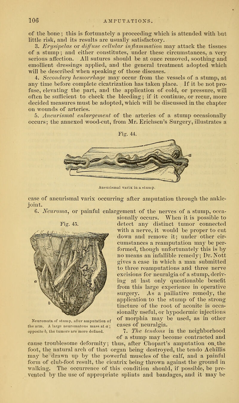 of the bone ; this is fortunately a proceeding which, is attended with but little risk, and its results are usually satisfactory. 3. Erysipelas or diffuse cellular inflammation may attack the tissues of a stump; and either constitutes, under these circumstances, a very serious affection. All sutures should be at once removed, soothing and emollient dressings applied, and the general treatment adopted which will be described when speaking of those diseases. 4. Secondary hemorrhage may occur from the vessels of a stump, at any time before complete cicatrization has taken place. If it be not pro- fuse, elevating the part, and the application of cold, or pressure, will often be sufficient to check the bleeding; if it continue, or recur, more decided measures must be adopted, which will be discussed in the chapter on wounds of ai'teries. 5. Aneurismal enlargement of the arteries of a stump occasionally occurs; the annexed wood-cut, from Mr. Erichsen's Surger}^, illustrates a Fiff. 44. Aneurismal varix in a stuujp. case of aneurismal varix occurring after amputation through the ankle- joint. 6. Neuroma, or painful enlargement of the nerves of a stump, occa- sionall}'^ occurs. When it is possible to Fig. 45. detect any distinct tumor connected with a nerve, it would be proper to cut down and remove it; under other cir- cumstances a reamputation may be per- formed, though unfortunately this is by no means an infallible remedy; Dr. Nott gives a case in which a man submitted to three reamputations aild three nerve excisions for neuralgia of a stump, deriv- ing at last only questionable benefit from this large experience in operative surgery. As a palliative remedy, the application to the stump of the strong tincture of the root of aconite is occa- sionally useful, or hypodermic injections of morphia may be used, as in other cases of neuralgia. Y. The teyidons in the neighborhood of a stump may become contracted and cause troublesome deformity; thus, after Chopart's amputation on,the foot, the natural arch of that organ being destroyed, the tendo Achillis may l)e drawn up by the powerful muscles of the calf, and a painful form of clul)-foot result, the cicatrix being thrown against the ground in walking. The occurrence of this condition should, if possible, be pre- vented by the use of approioriate si)lints and bandages, and it may be Neuromata of stump, after amputation of tlie arm. A large neuromatous mass at a ; opposite b, the tumors are more defined.
